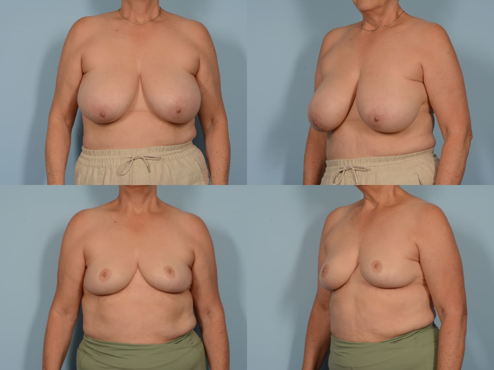 Breast Reduction Case# 1168 Combined Image