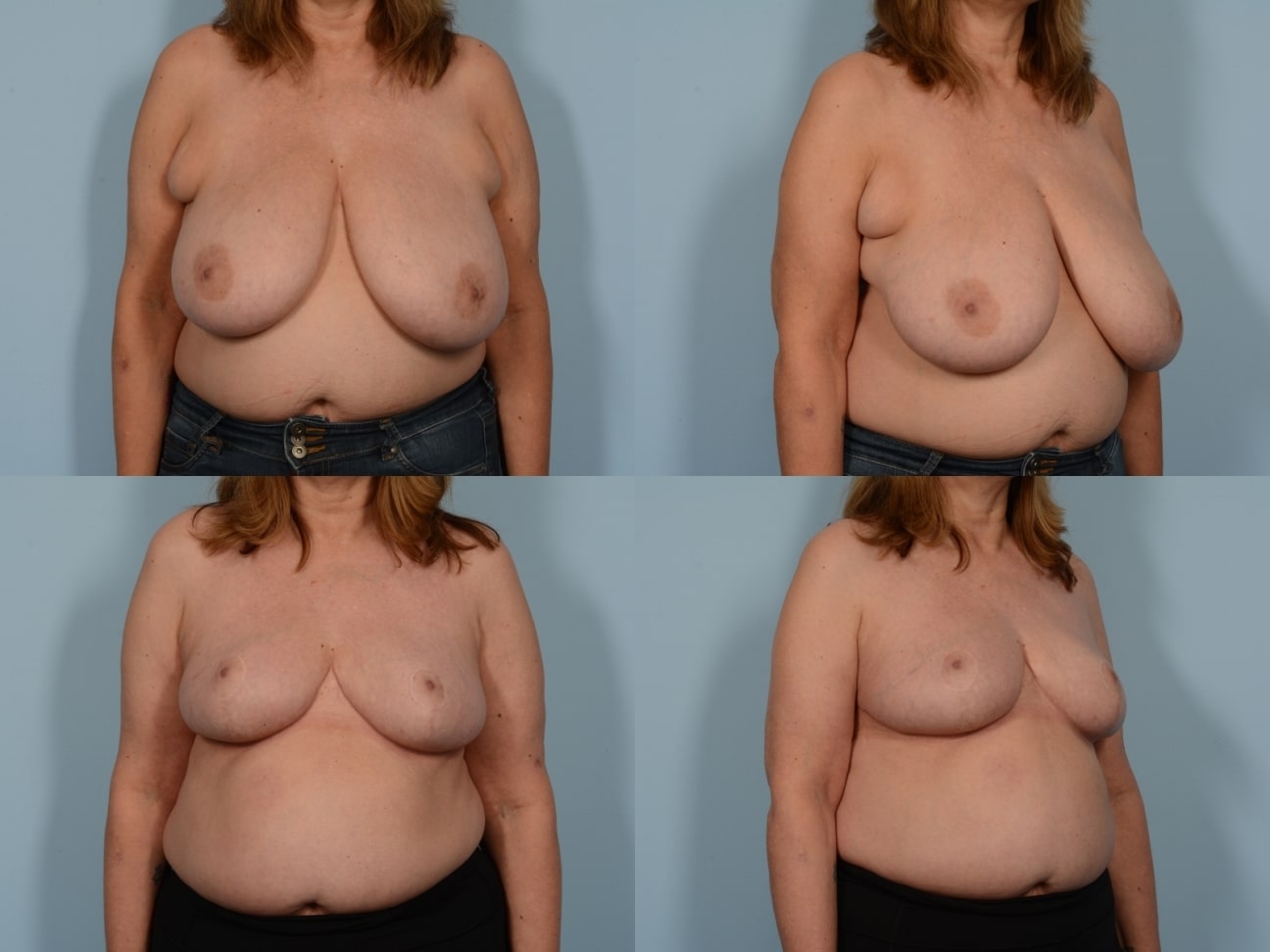 Breast Reduction Case# 1179 Combined Image