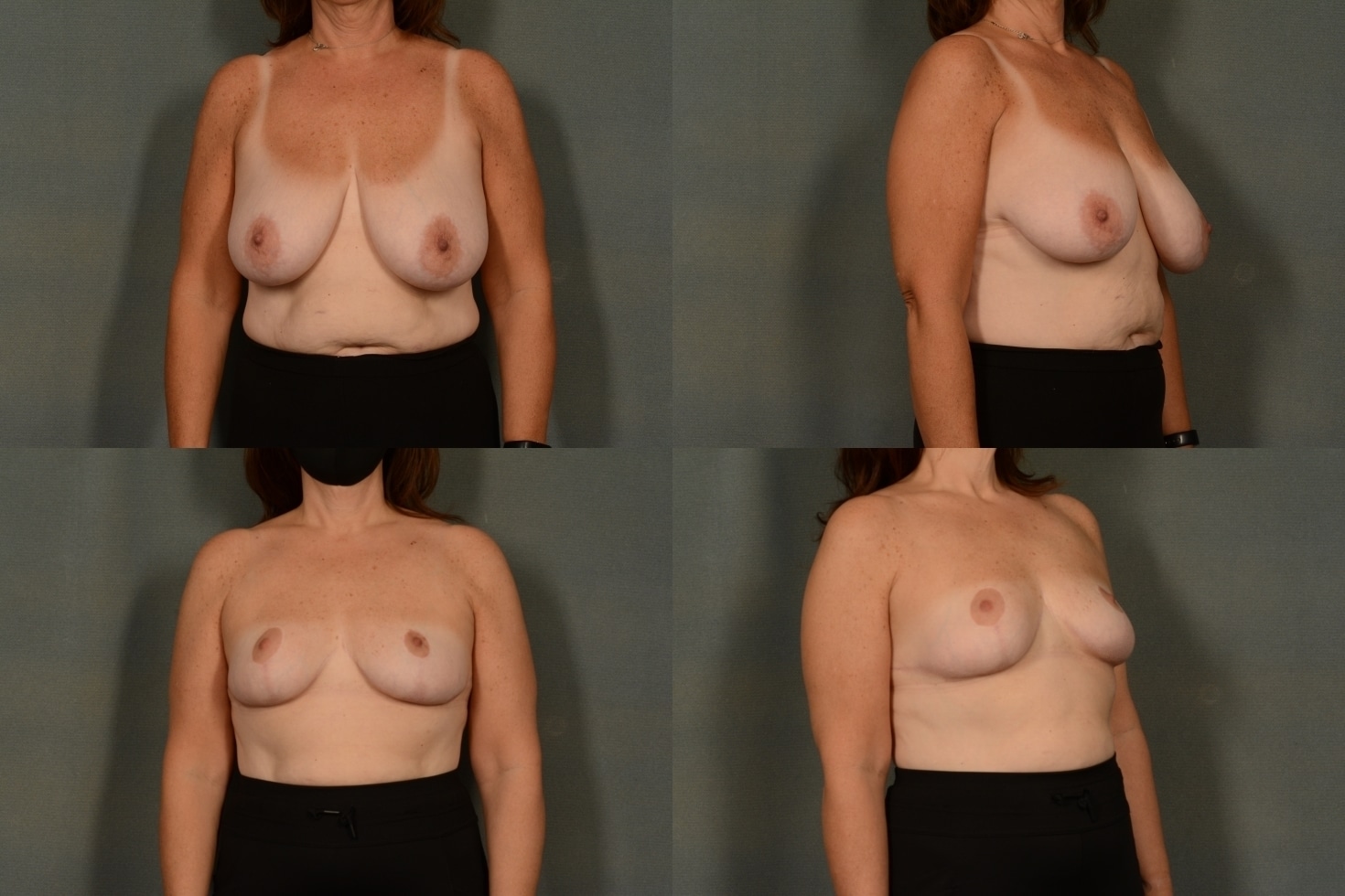 Breast Reduction Case# 976 Combined Image