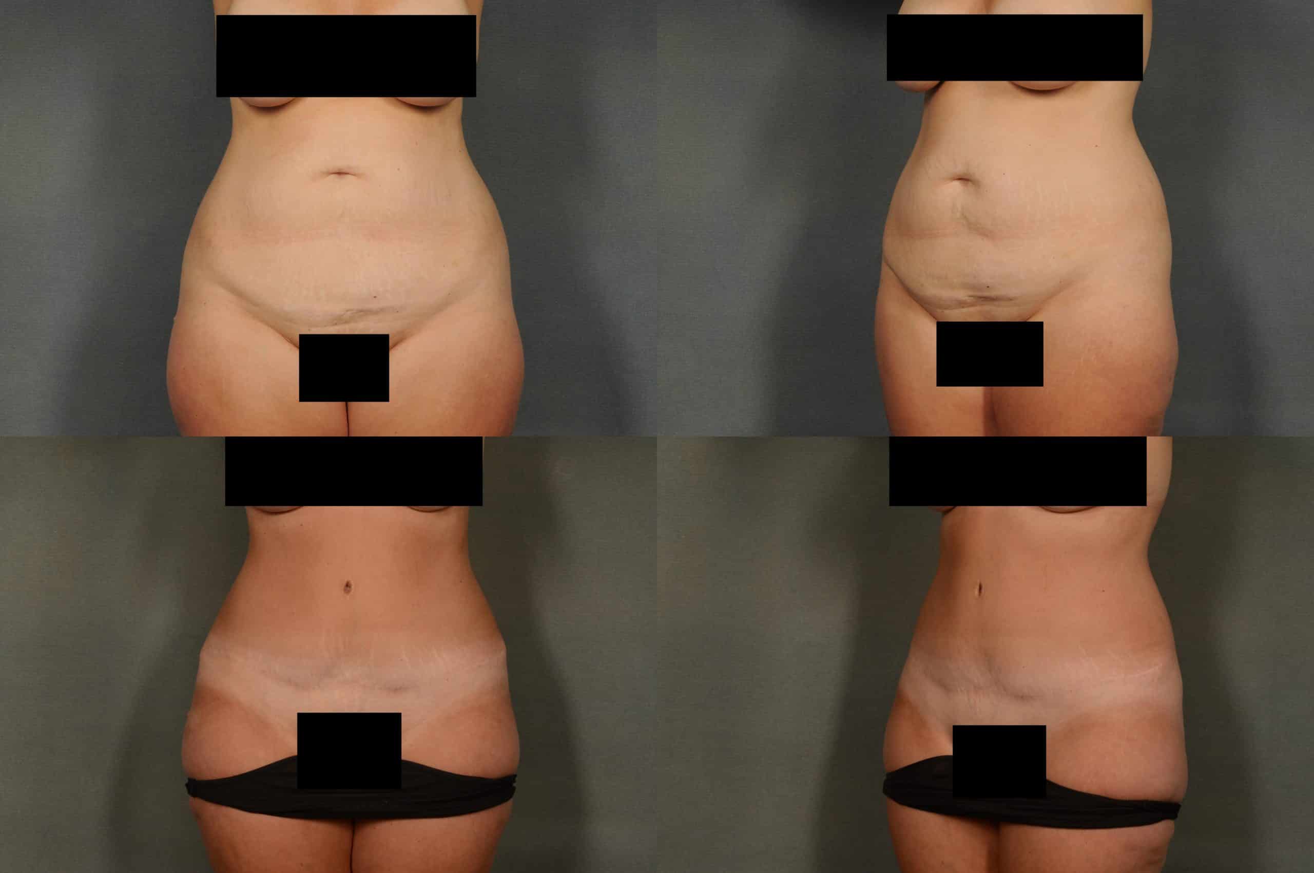 Tummy Tuck Case # 961 Combined Image
