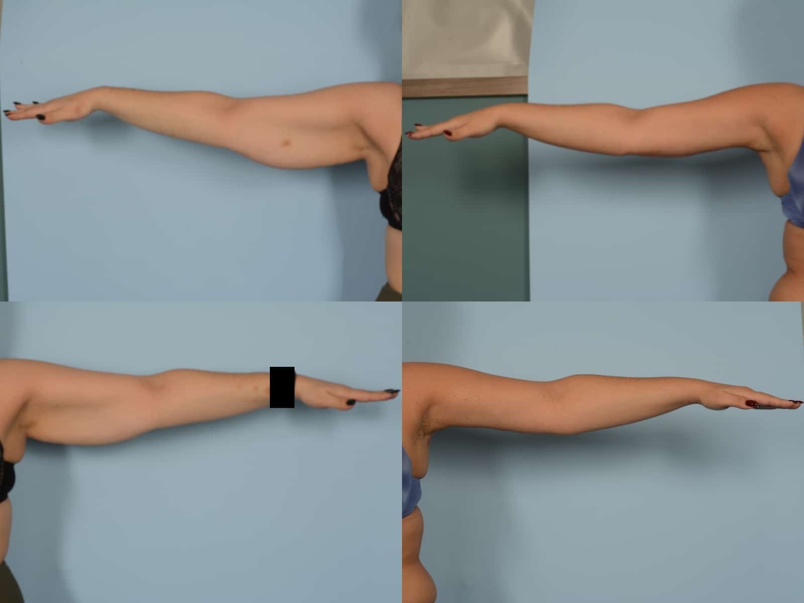 Arm Lift Case# 1175 Combined Image