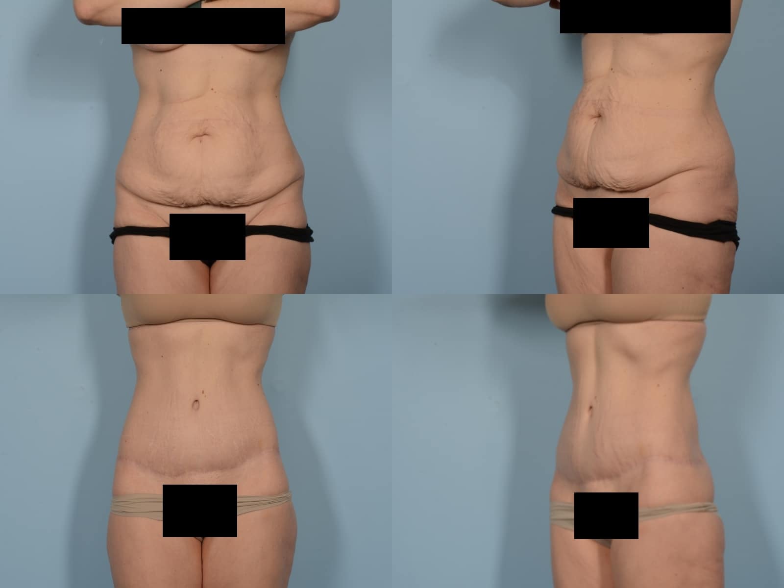 Tummy Tuck Case# 1193 Combined Image