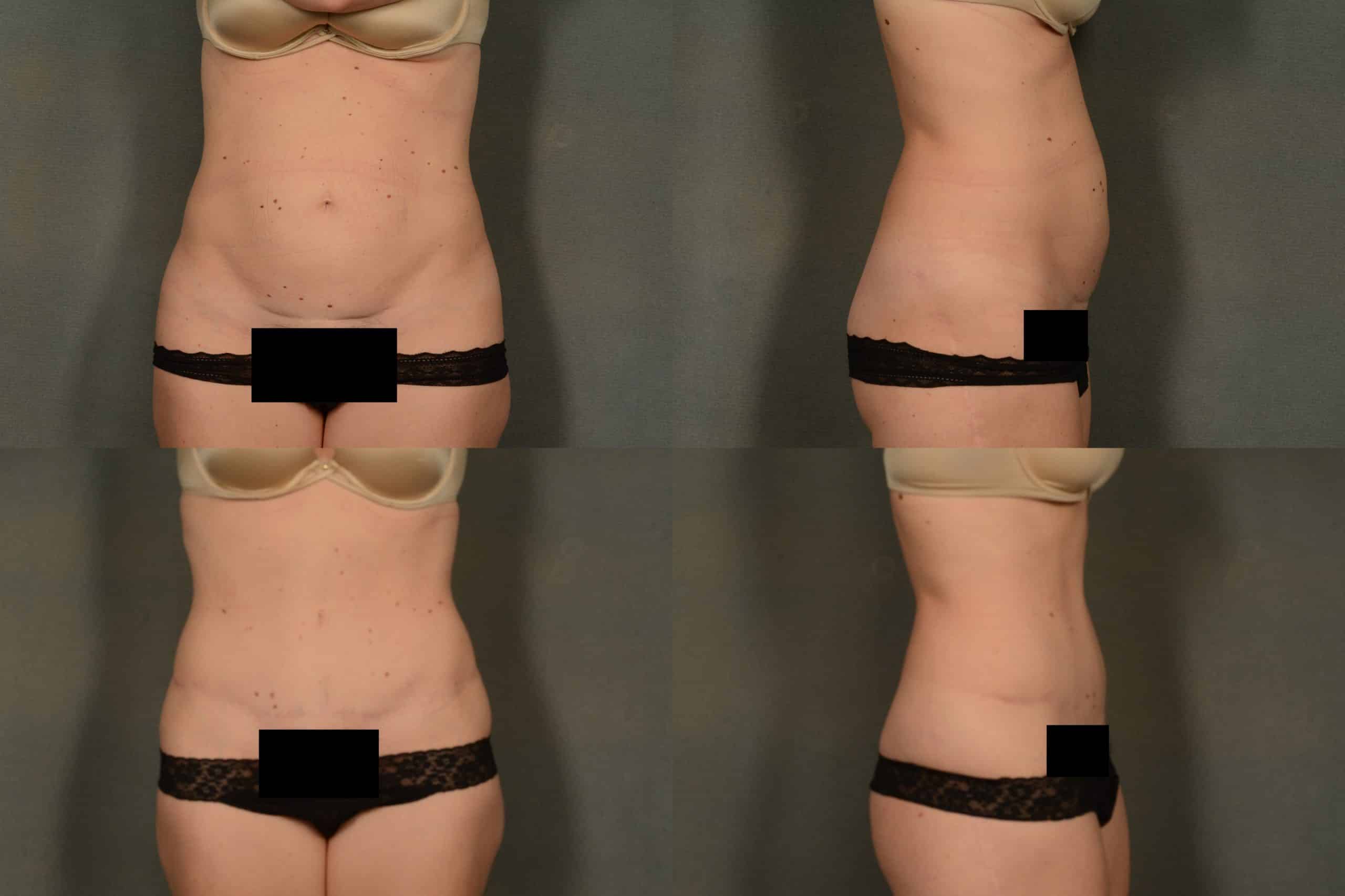 Tummy Tuck Case# 1009 Combined Image