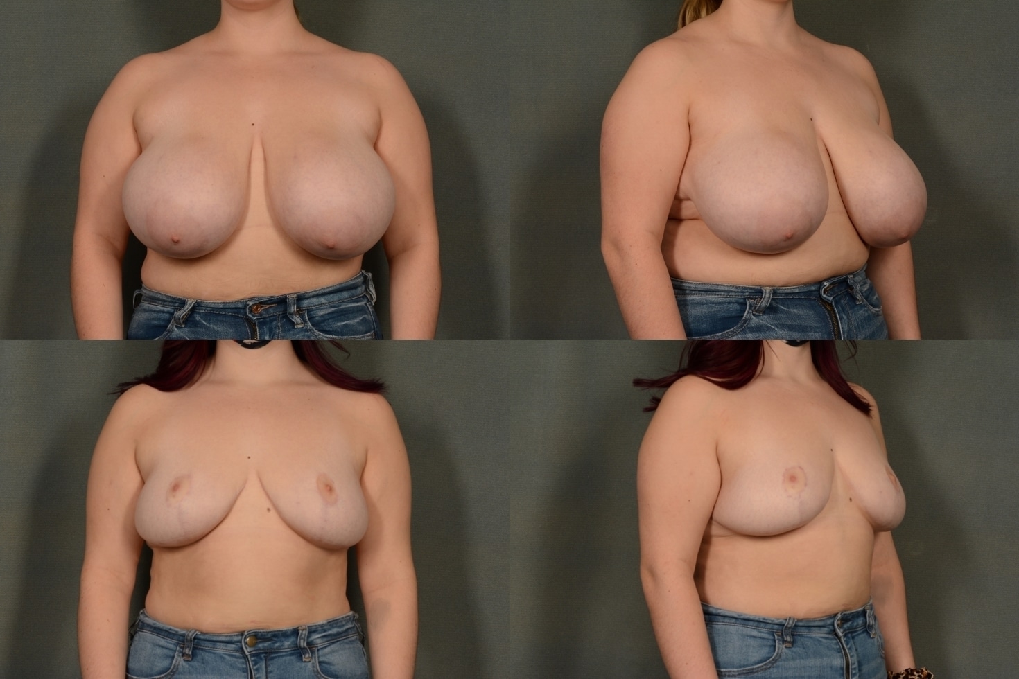 Breast Reduction Case# 977 Combined Image