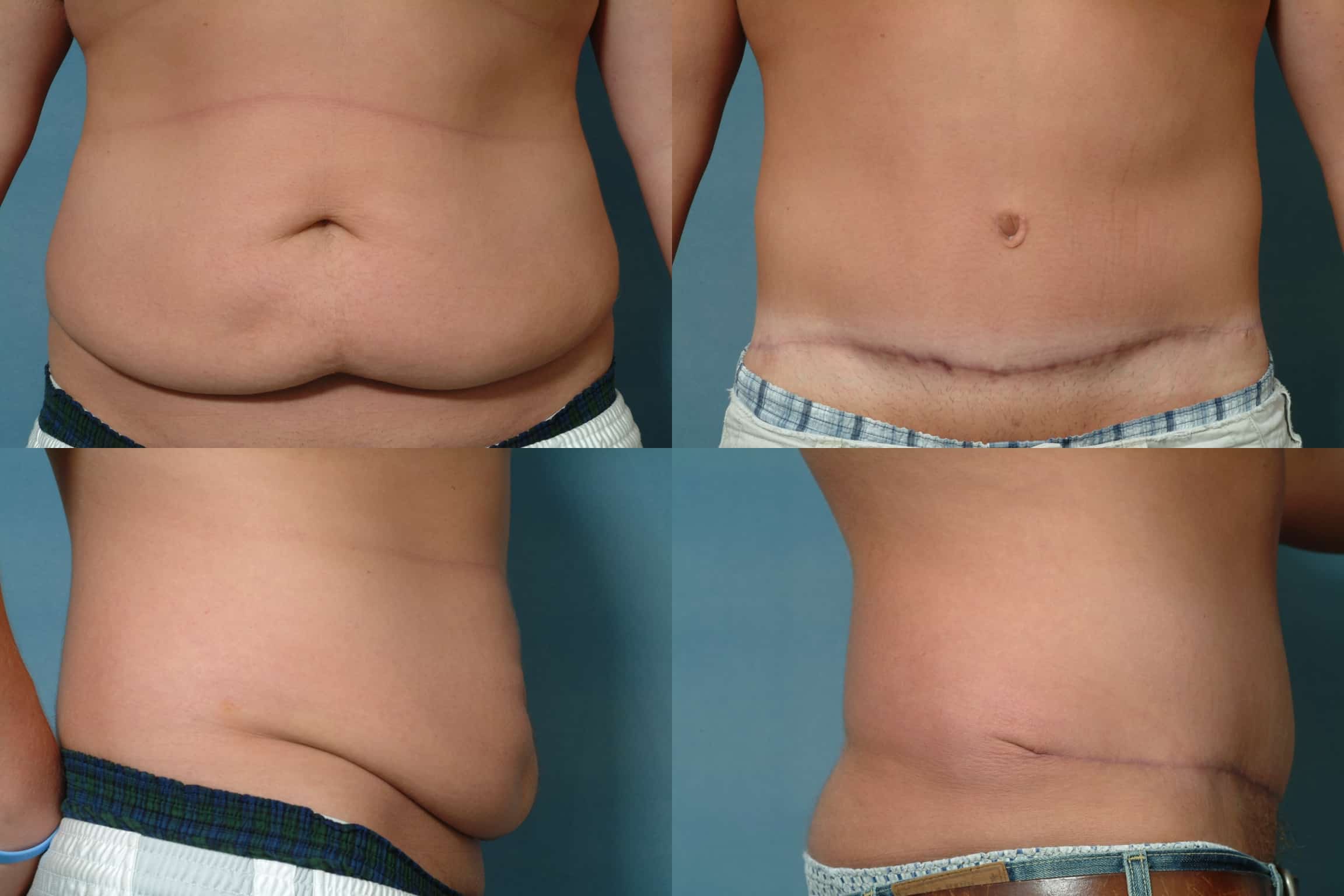 Tummy Tuck Case# 168 Combined Image