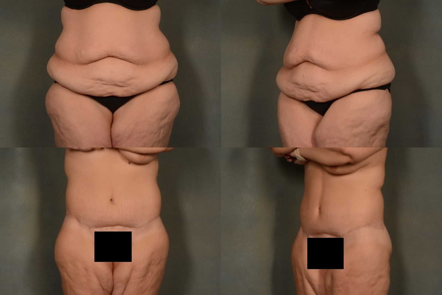 Tummy Tuck Case# 1041 Combined Image