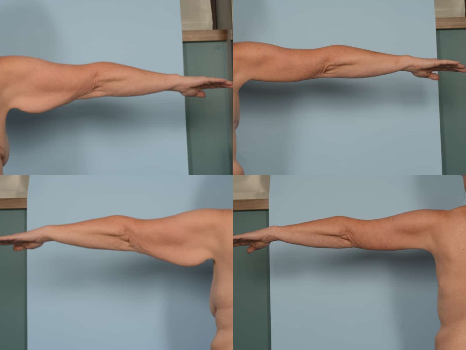 Arm Lift Case# 1169 Combined Image