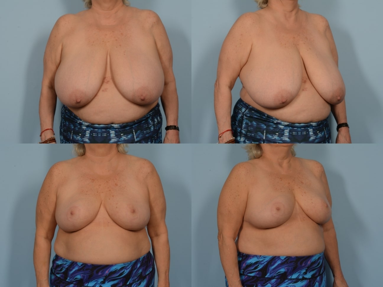 Breast Reduction Case# 1204 Combined Image