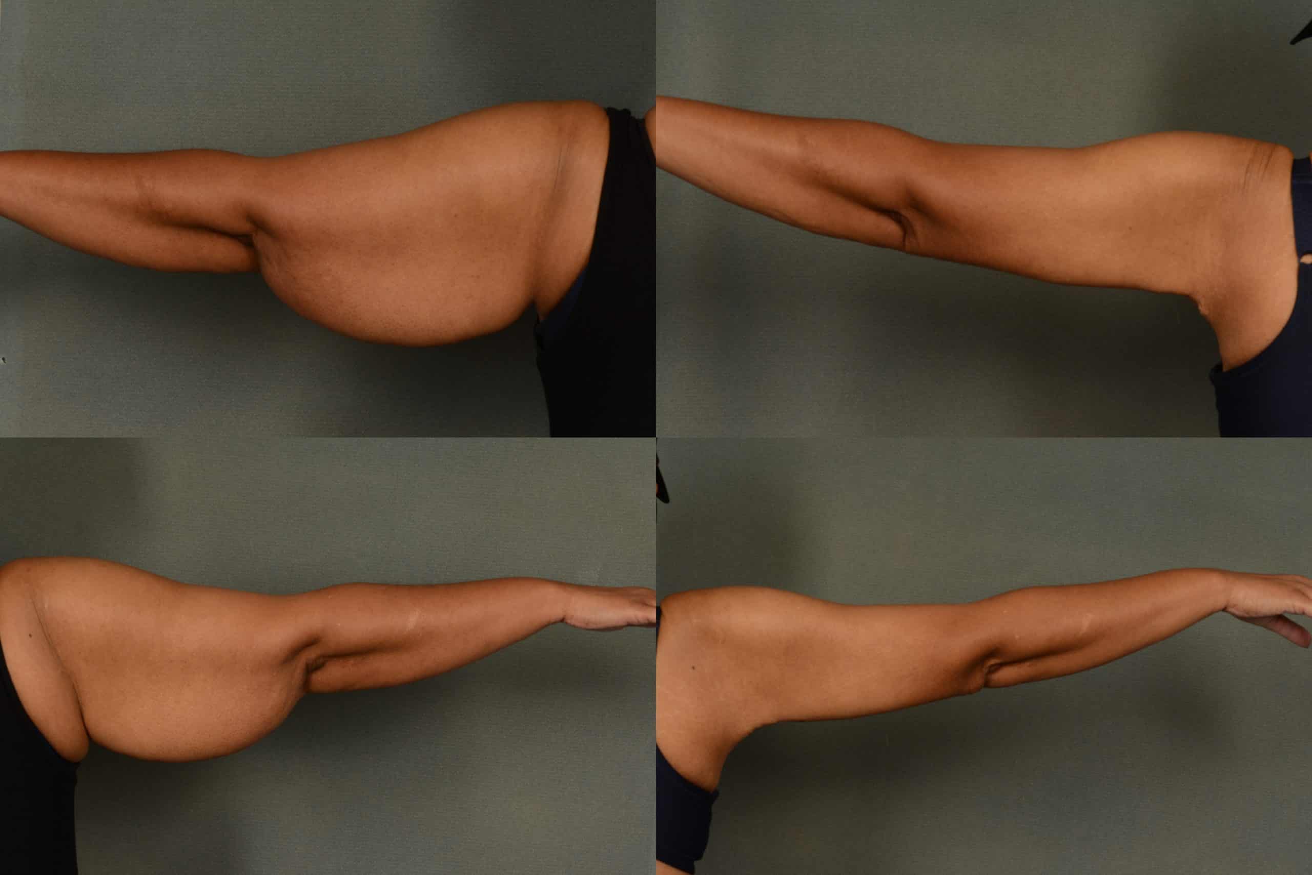 Arm Lift Case# 982 Combined Image