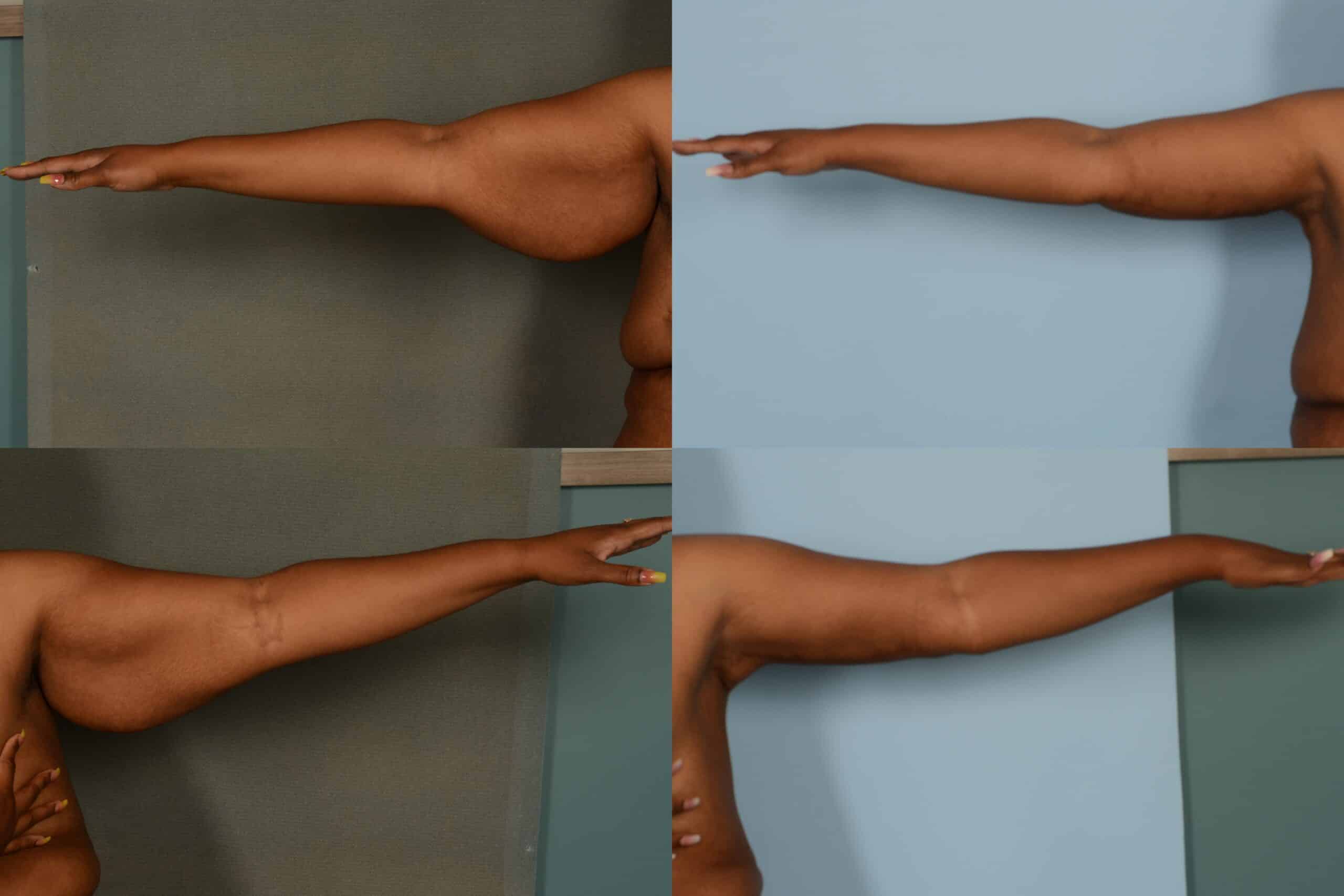 Arm Lift Case# 1088 Combined Image