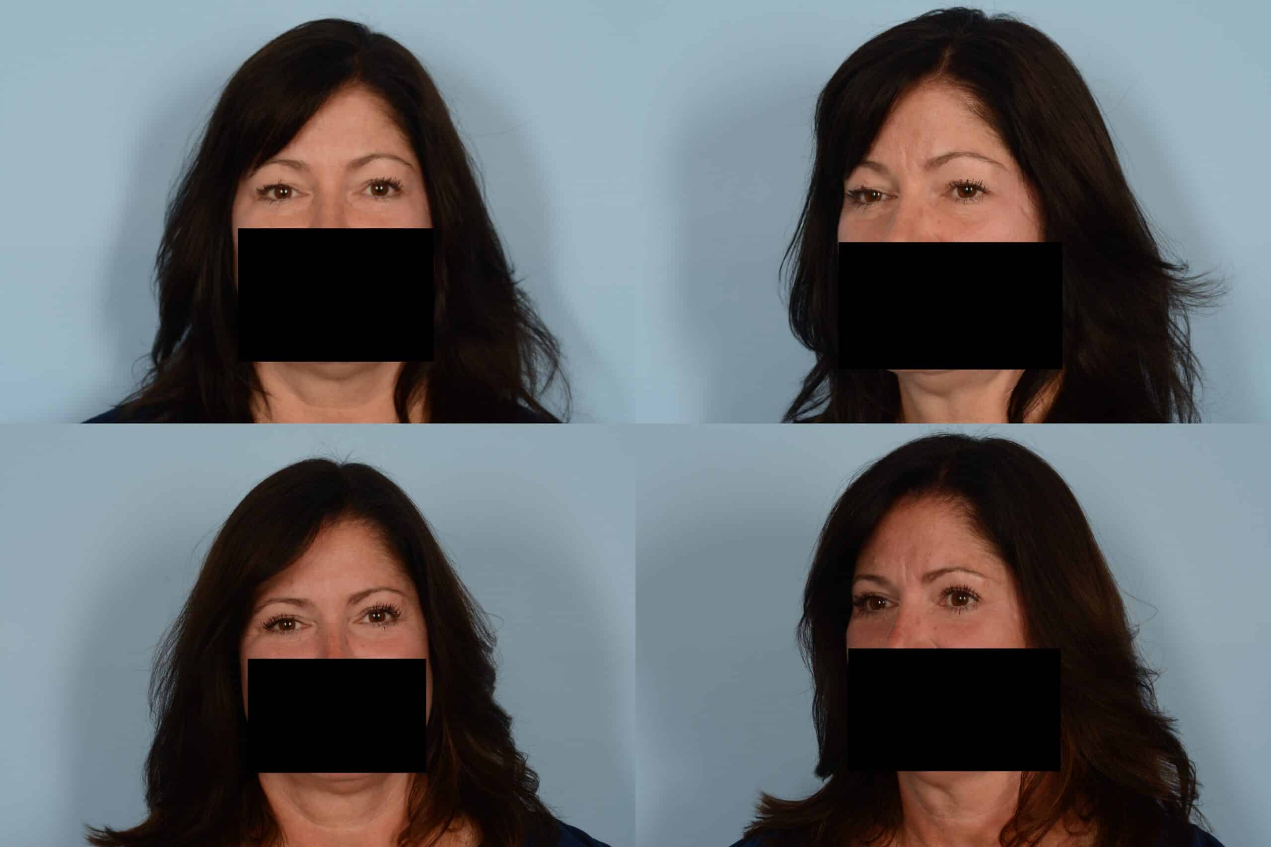 Blepharoplasty Case# 1113 Combined Image