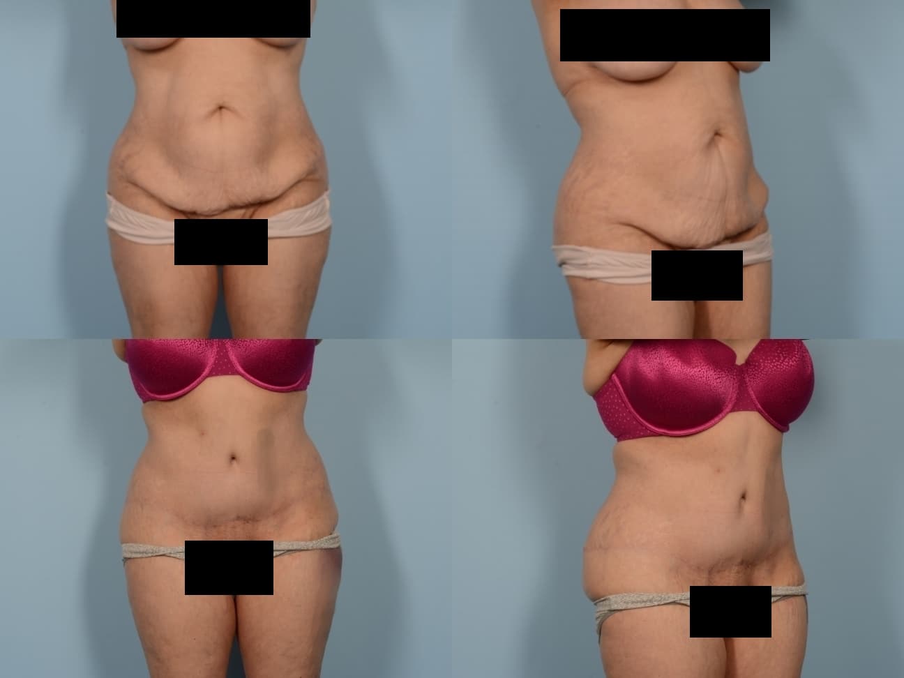 Tummy Tuck Case# 1170 Combined Image