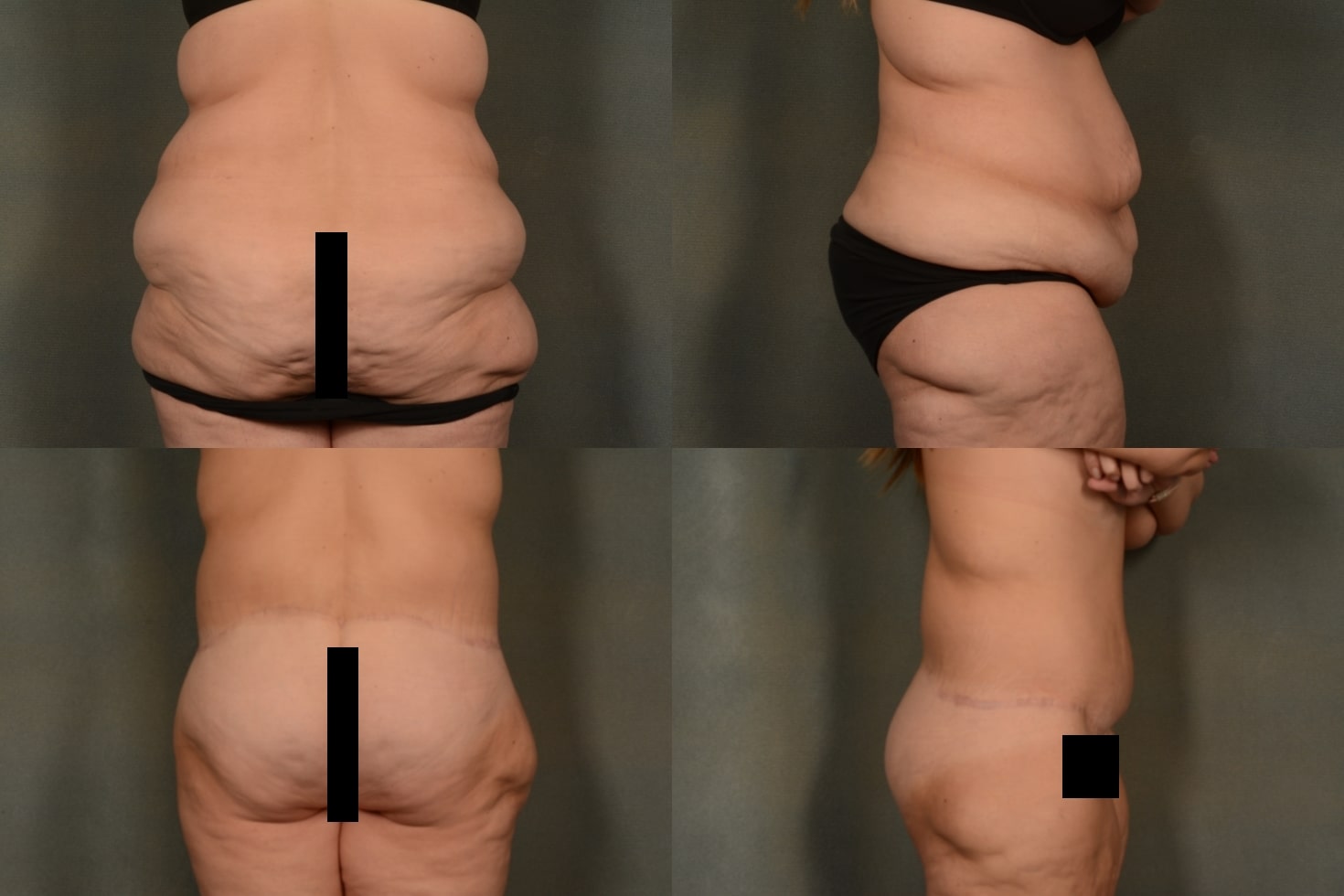 Back Lift Case# 1042 Combined Image