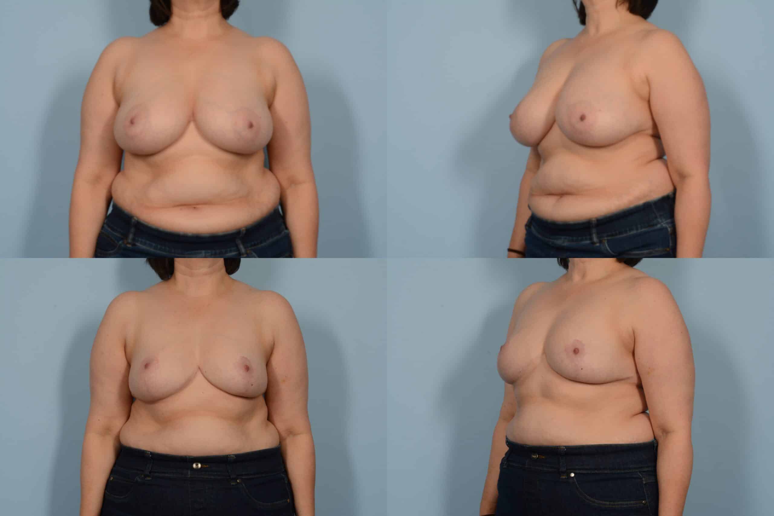 Breast Reduction Case# 1149 Combined Image
