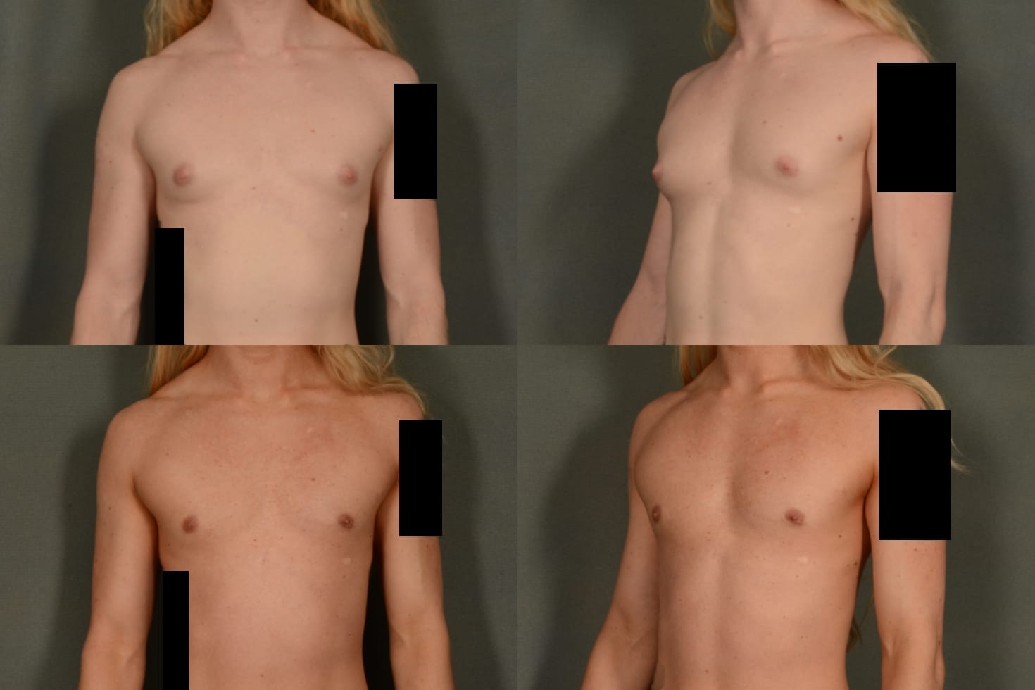 Male Breast Reduction Case# 1024 Combined Image