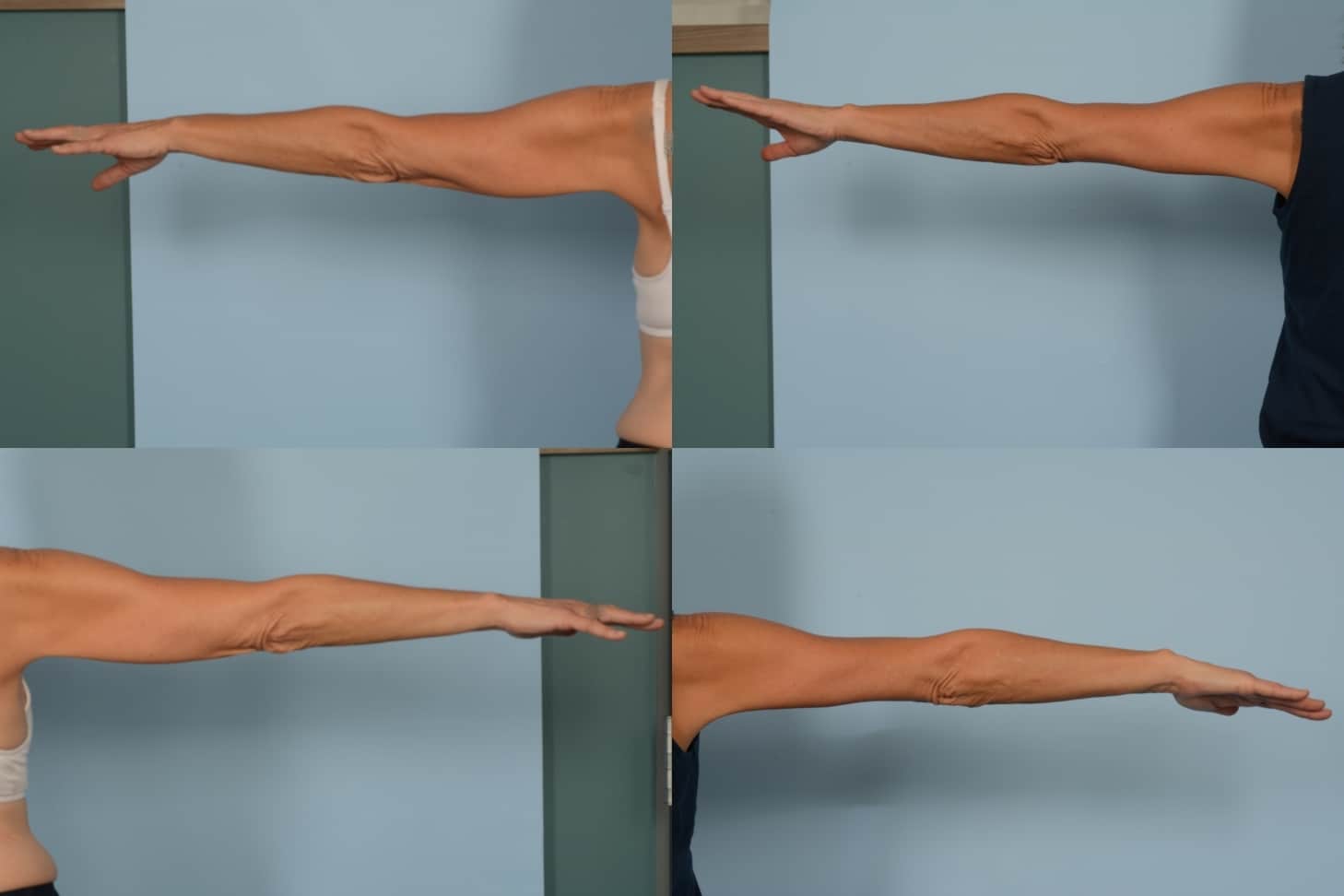 Arm Lift Case# 1149 Combined Image