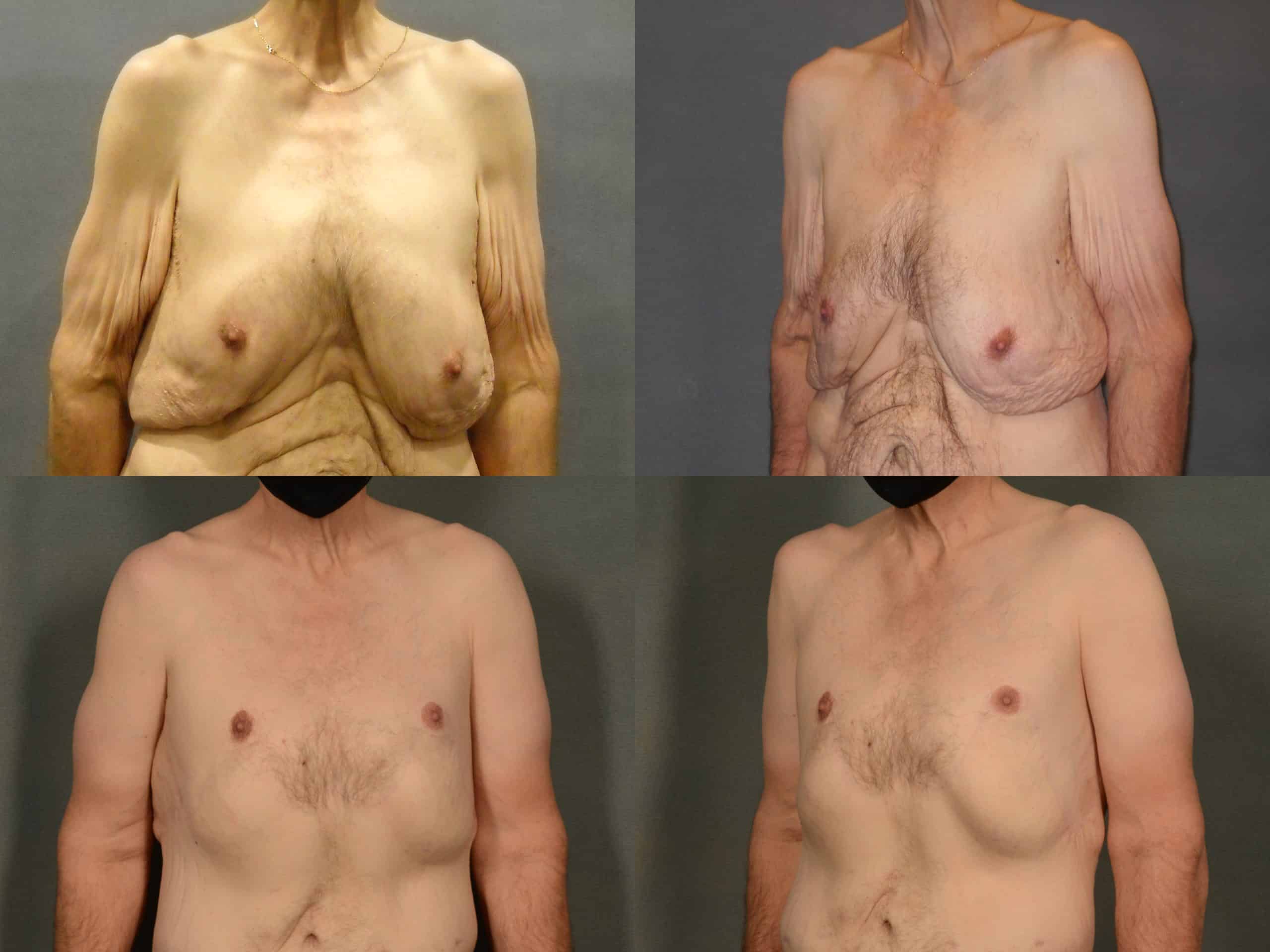 Male Breast Reduction Case# 986 Combined Image