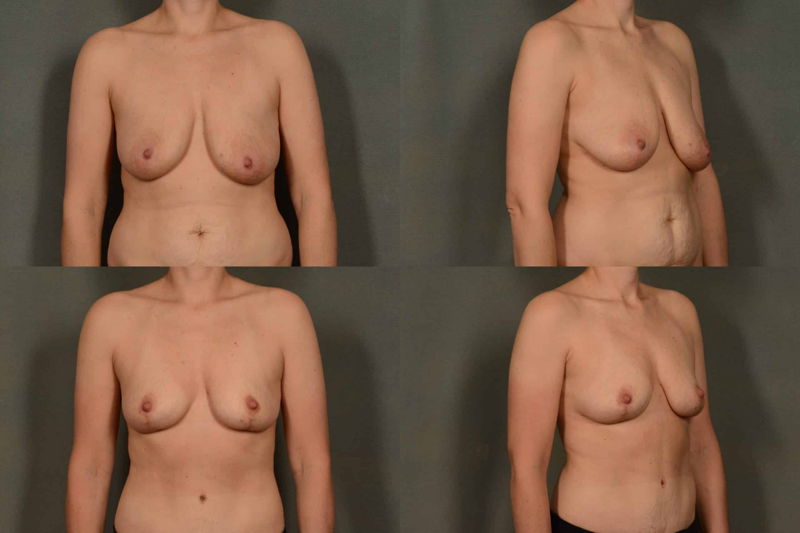 Breast Lift Case# 1030 Combined Image