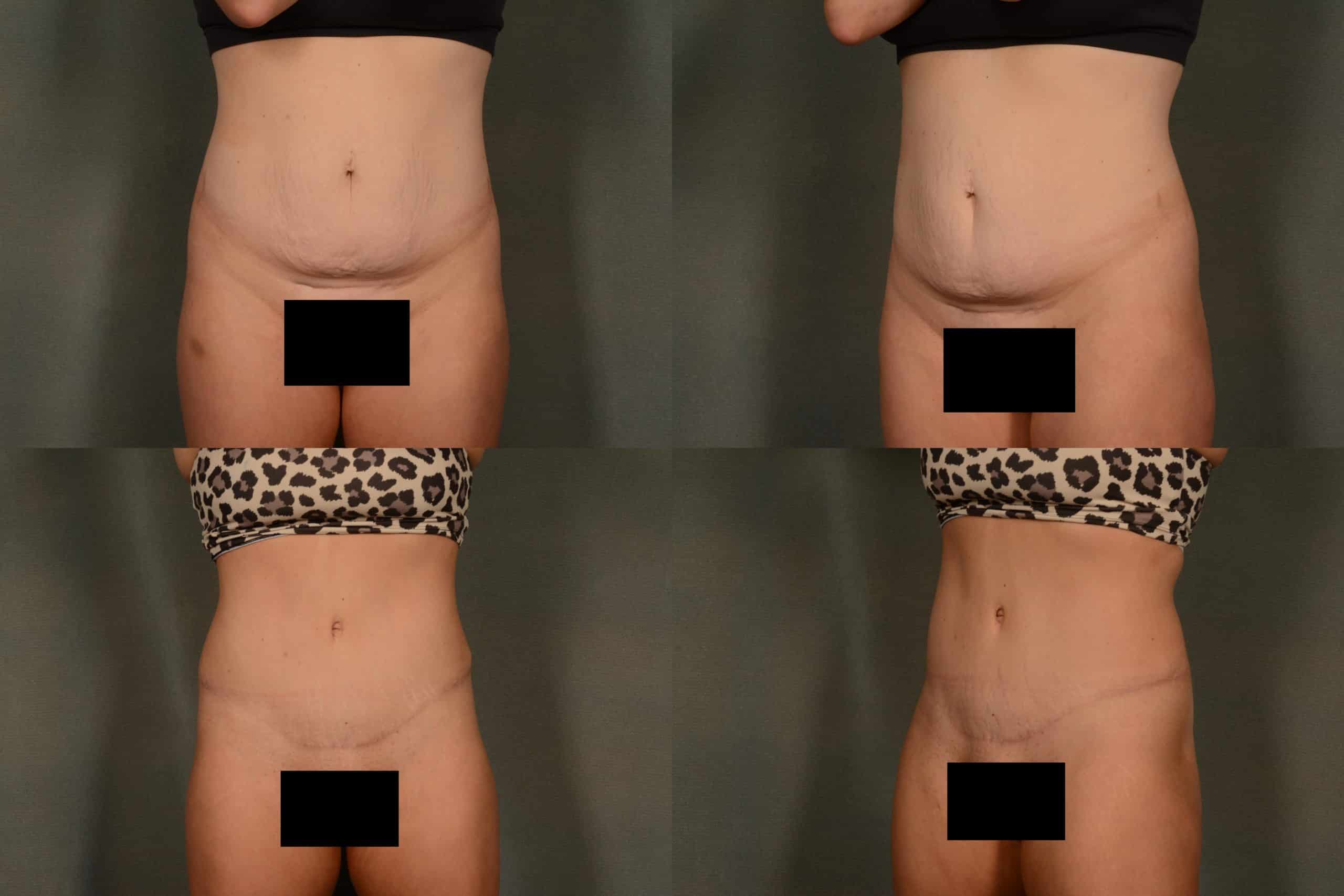 Tummy Tuck Case# 1040 Combined Image