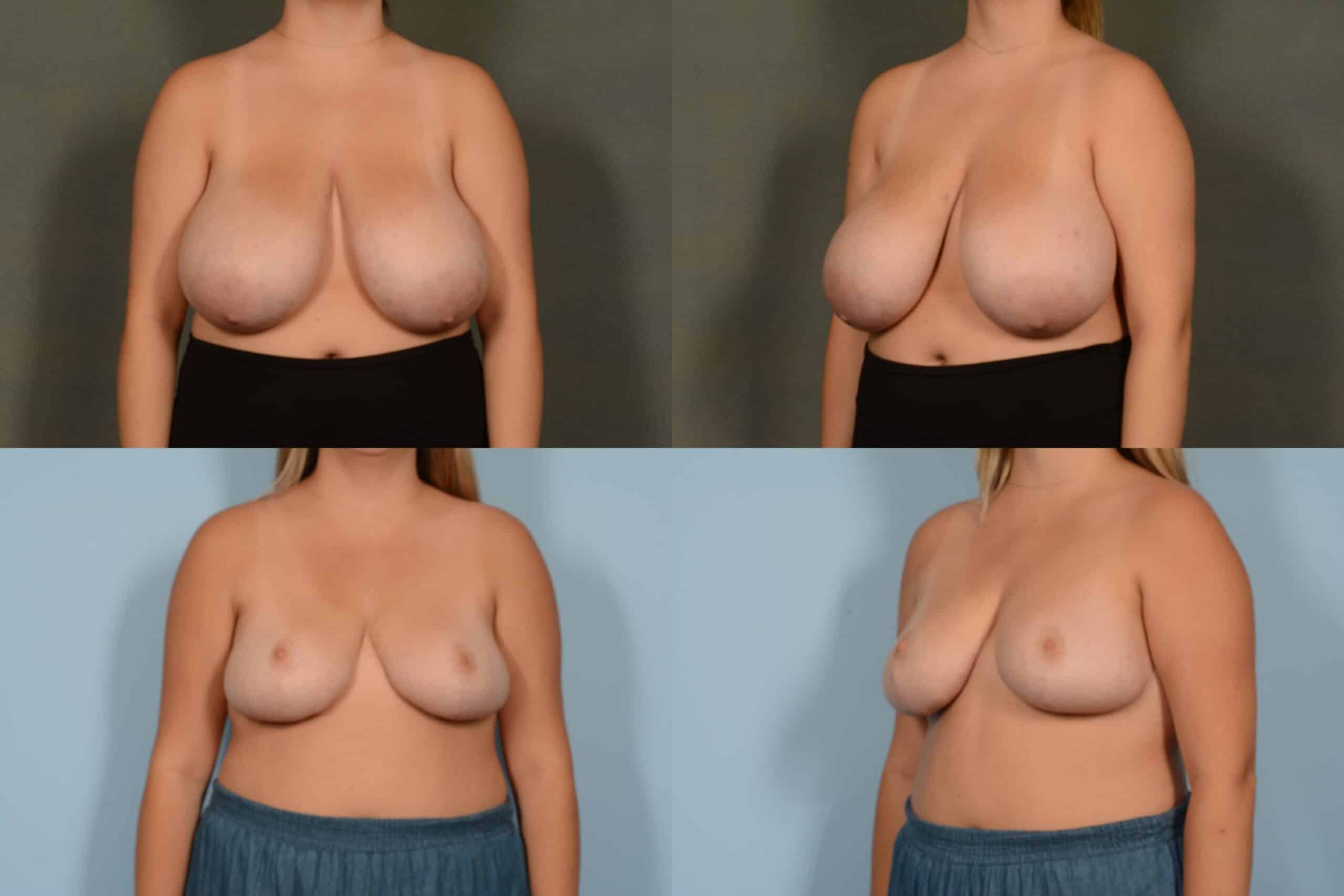 Breast Reduction Case# 1119 Combined Image