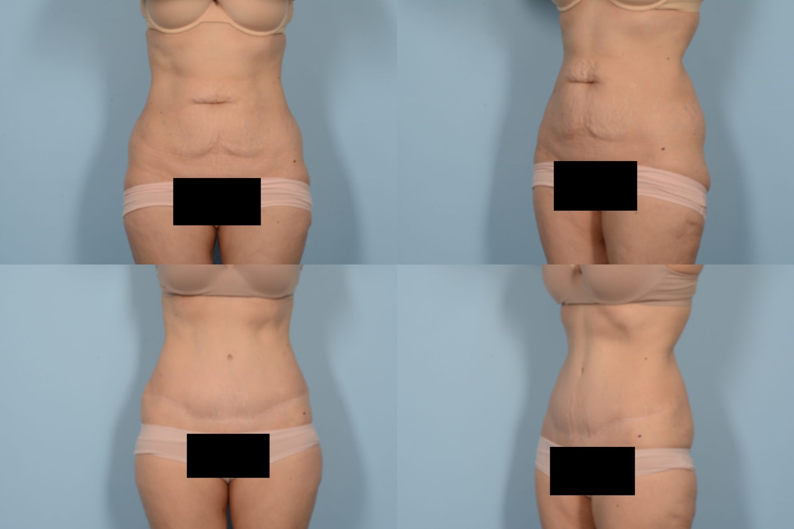 Tummy Tuck Case# 1124 Combined Image