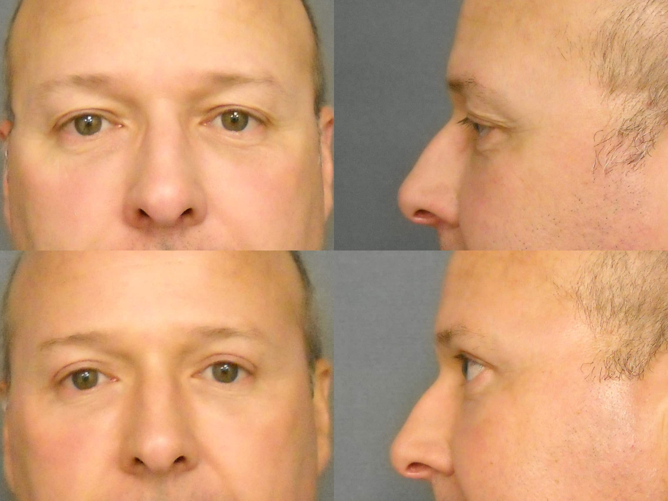 Blepharoplasty Case# 303 Combined Image