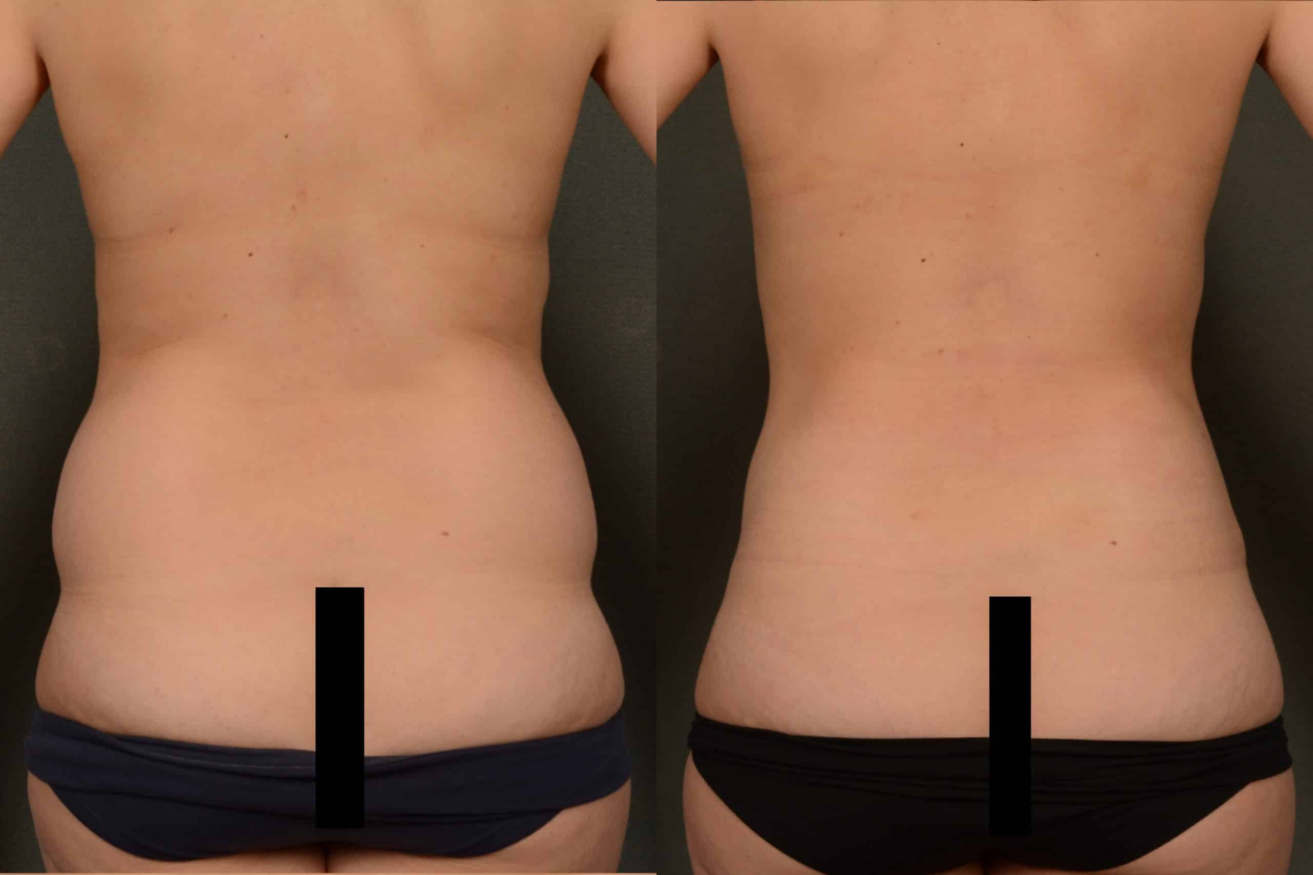 Liposuction Case# 1037 Combined Image