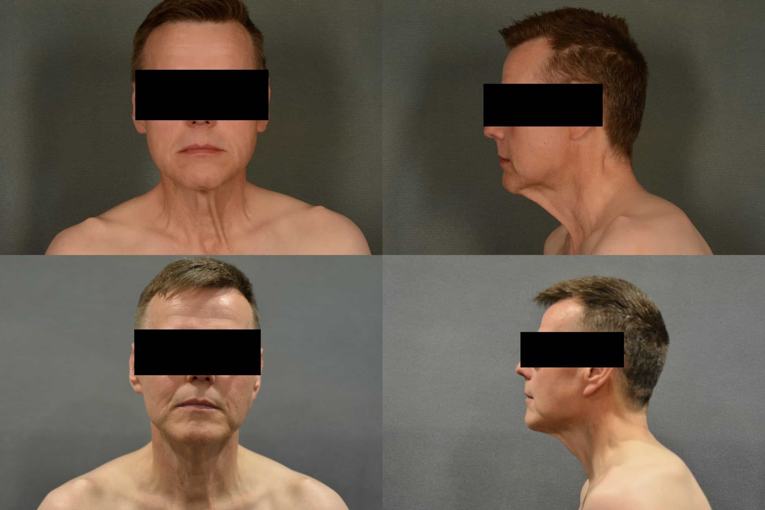 Neck Lift Case# 1031 Combined Image