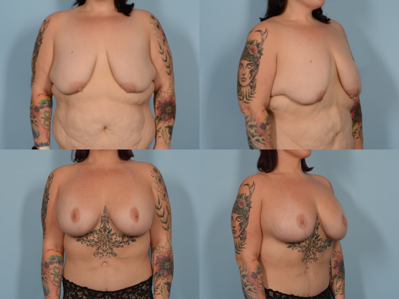 Breast Lift with Augmentation Case# 1196 Combined Image