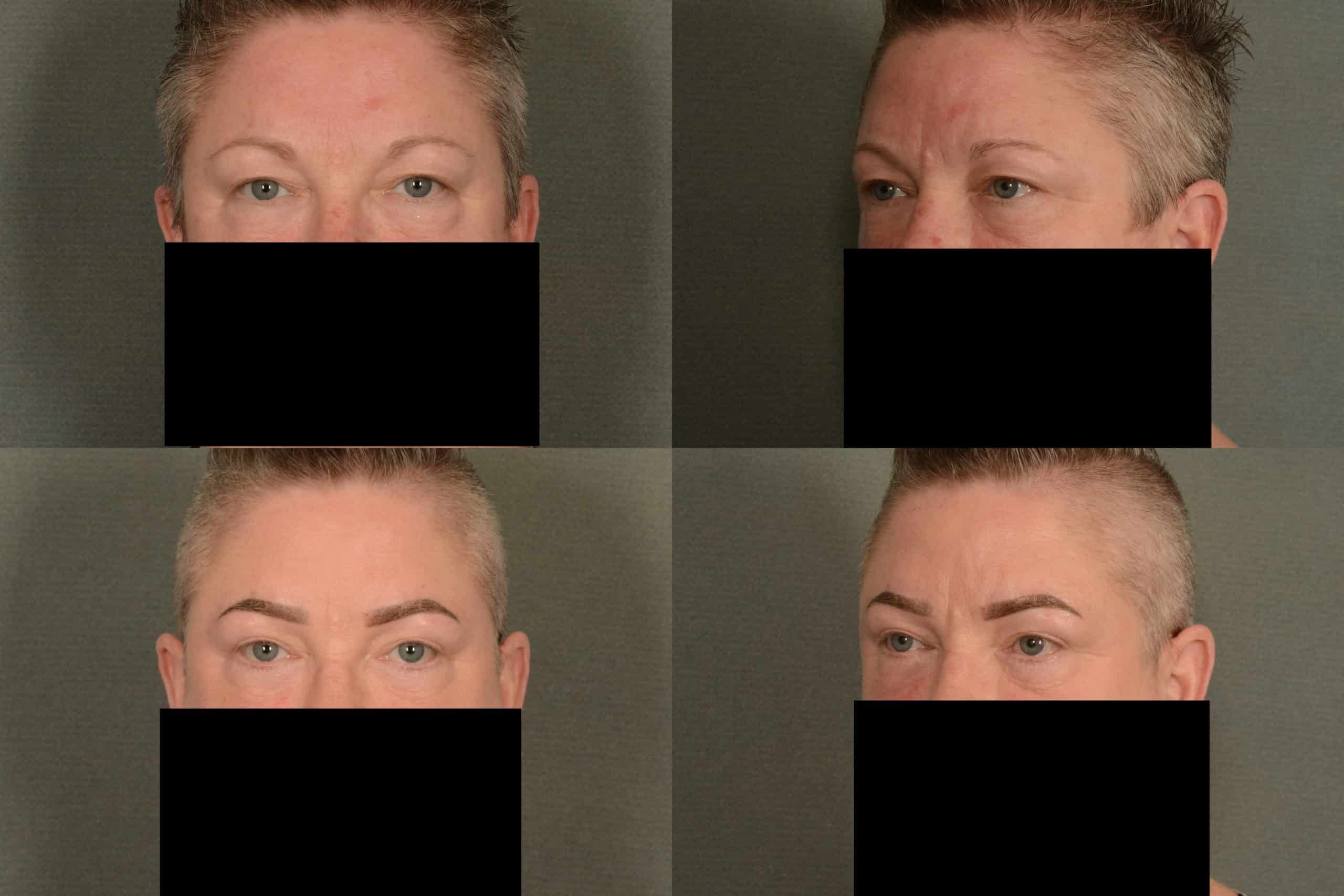 Blepharoplasty Case# 1020 Combined Image