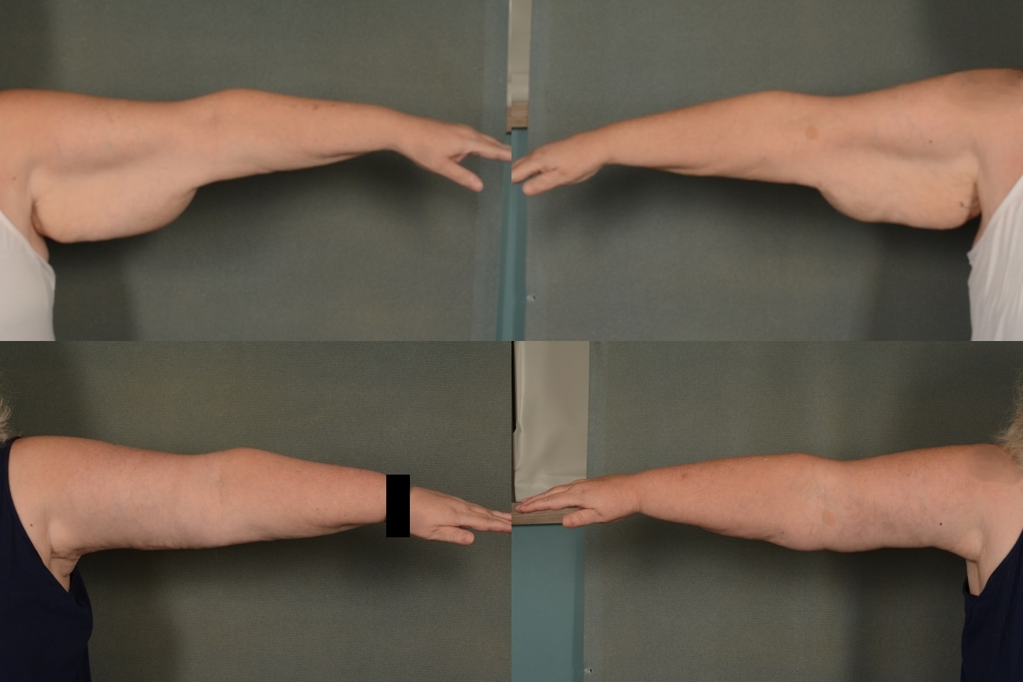 Arm Lift Case# 963 Combined Image