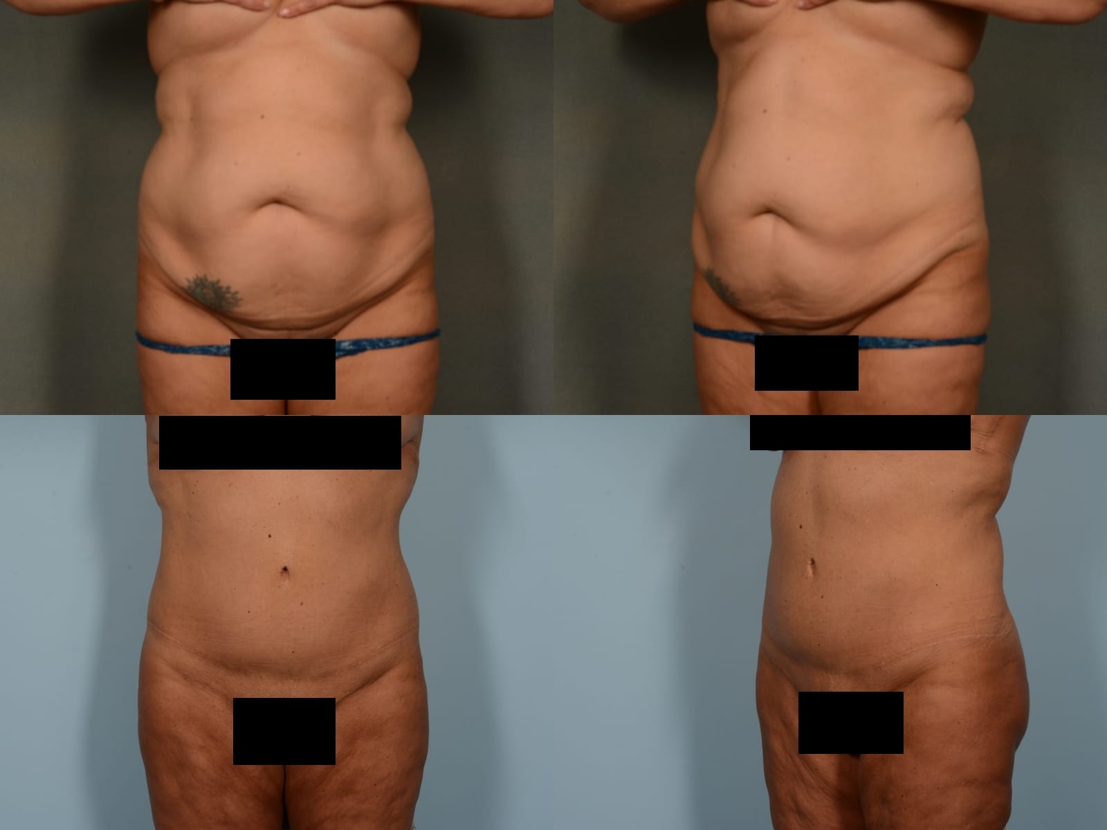 Tummy Tuck Case# 1159 Combined Image