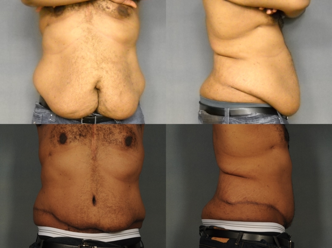 Tummy Tuck Case# 941 Combined Image