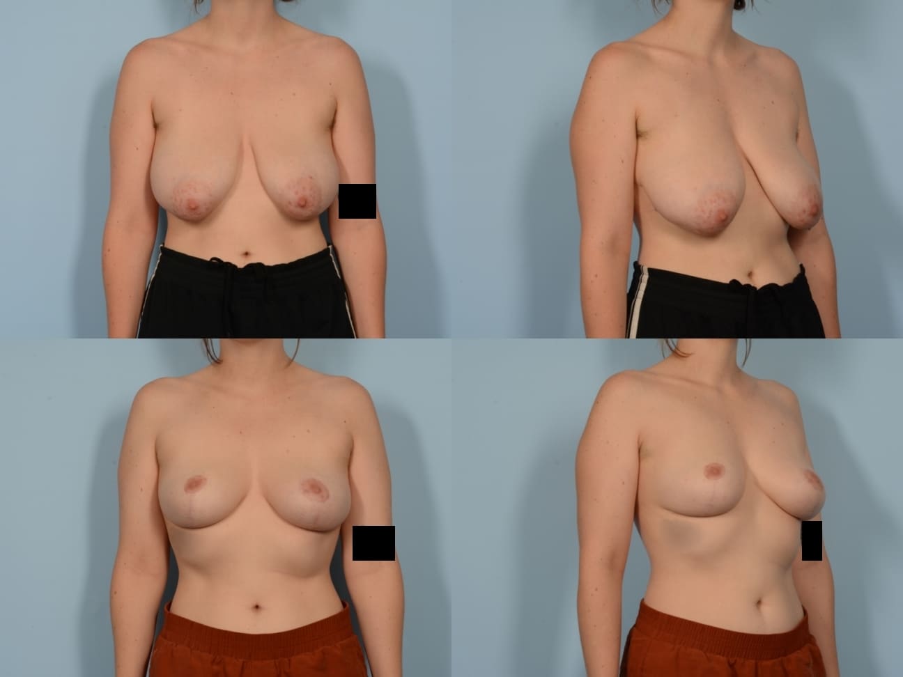 Breast Reduction Case# 1164 Combined Image