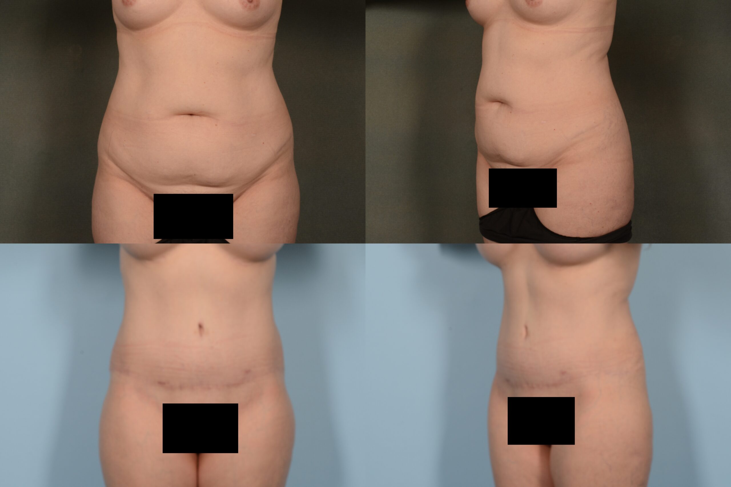 Tummy Tuck Case# 1091 Combined Image