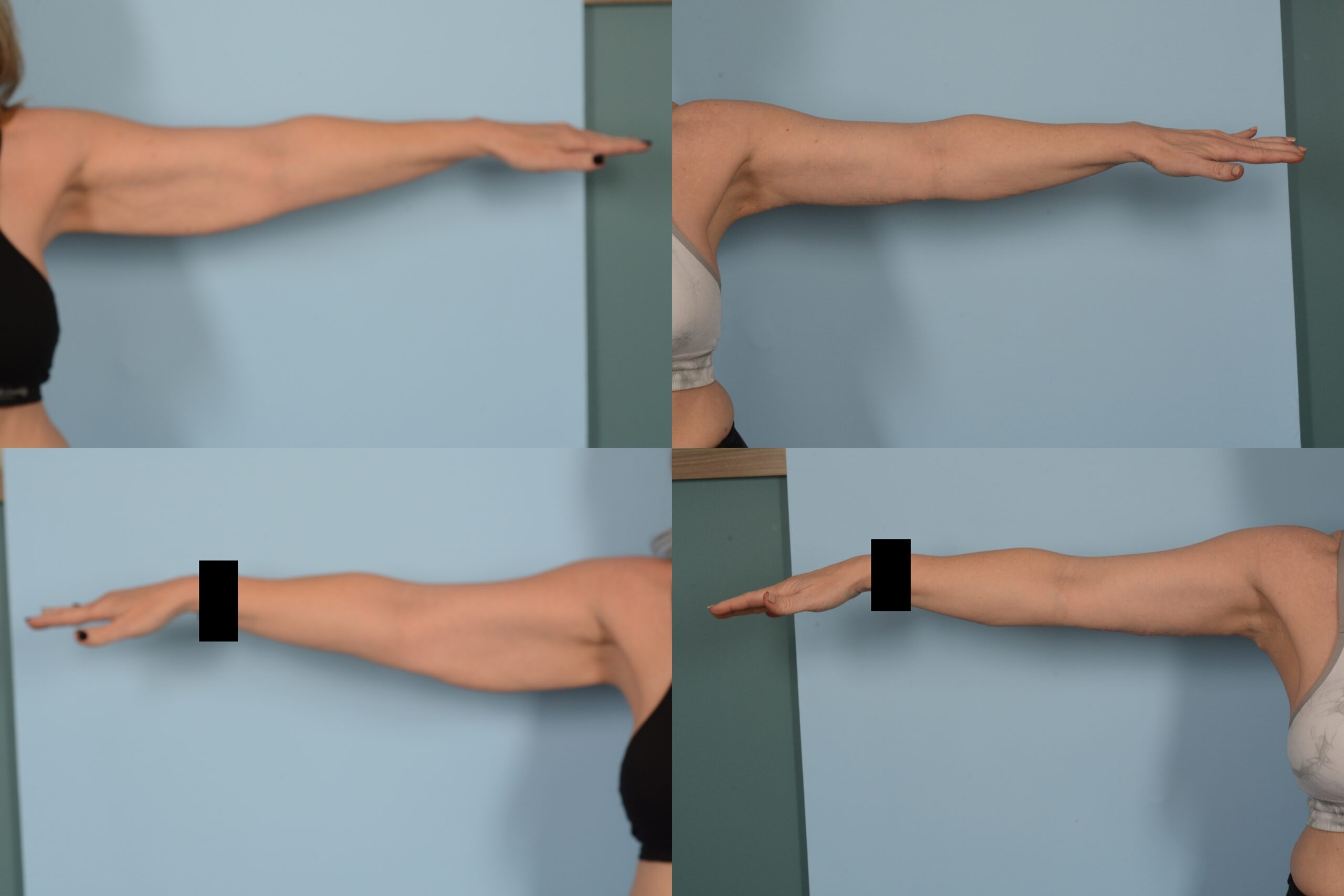 Arm Lift Case# 1141 Combined Image