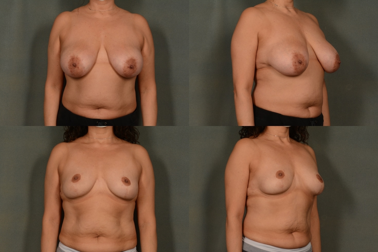 Breast Reduction Case# 1016 Combined Image