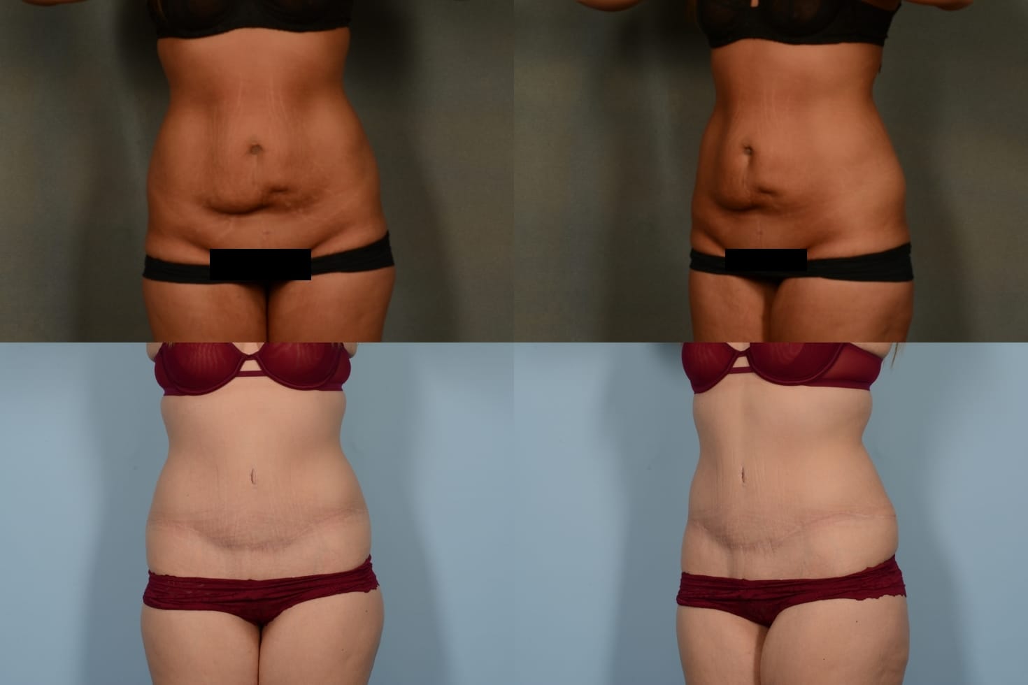 Tummy Tuck Case# 1101 Combined Image