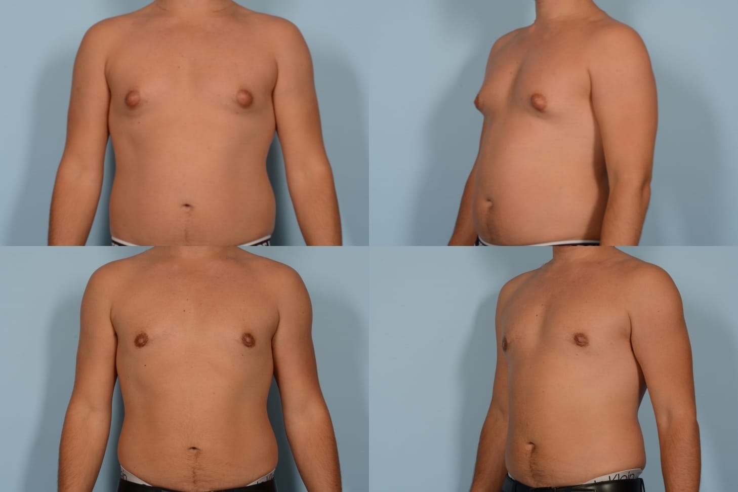 Male Breast Reduction Case# 1125 Combined Image