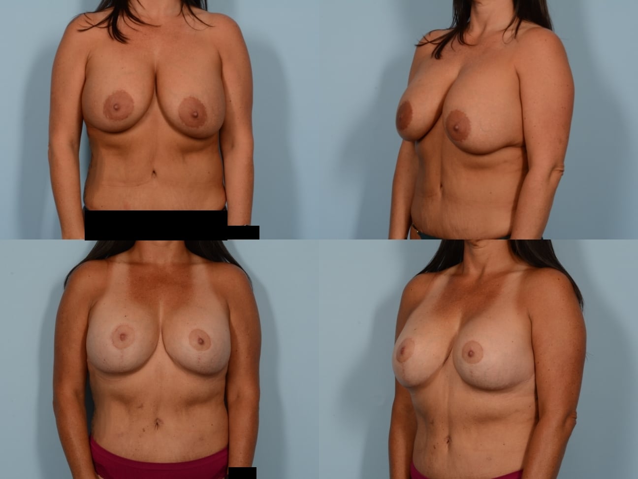 Breast Lift with Augmentation Case# 1172 Combined Image