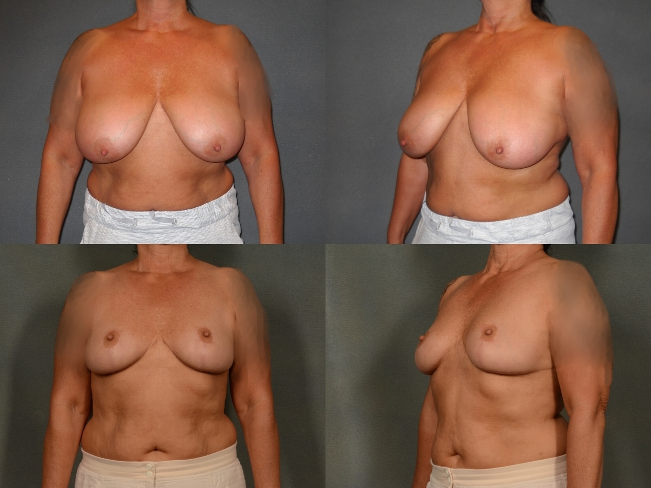 Breast Reduction Case# 967 Combined Image