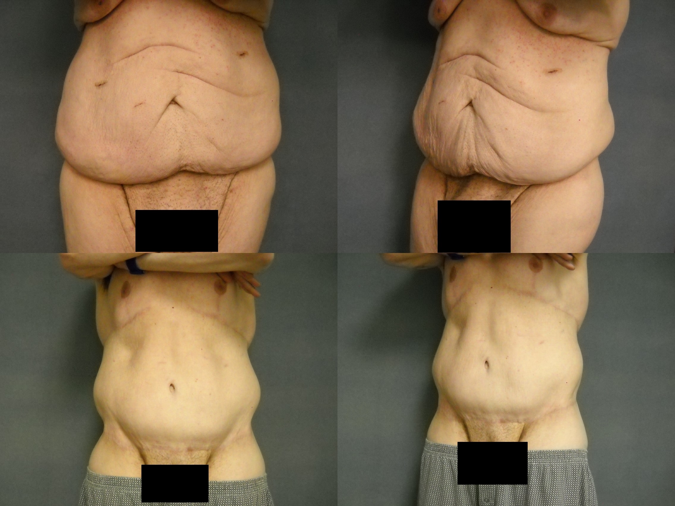 Tummy Tuck Case# 253 Combined Image