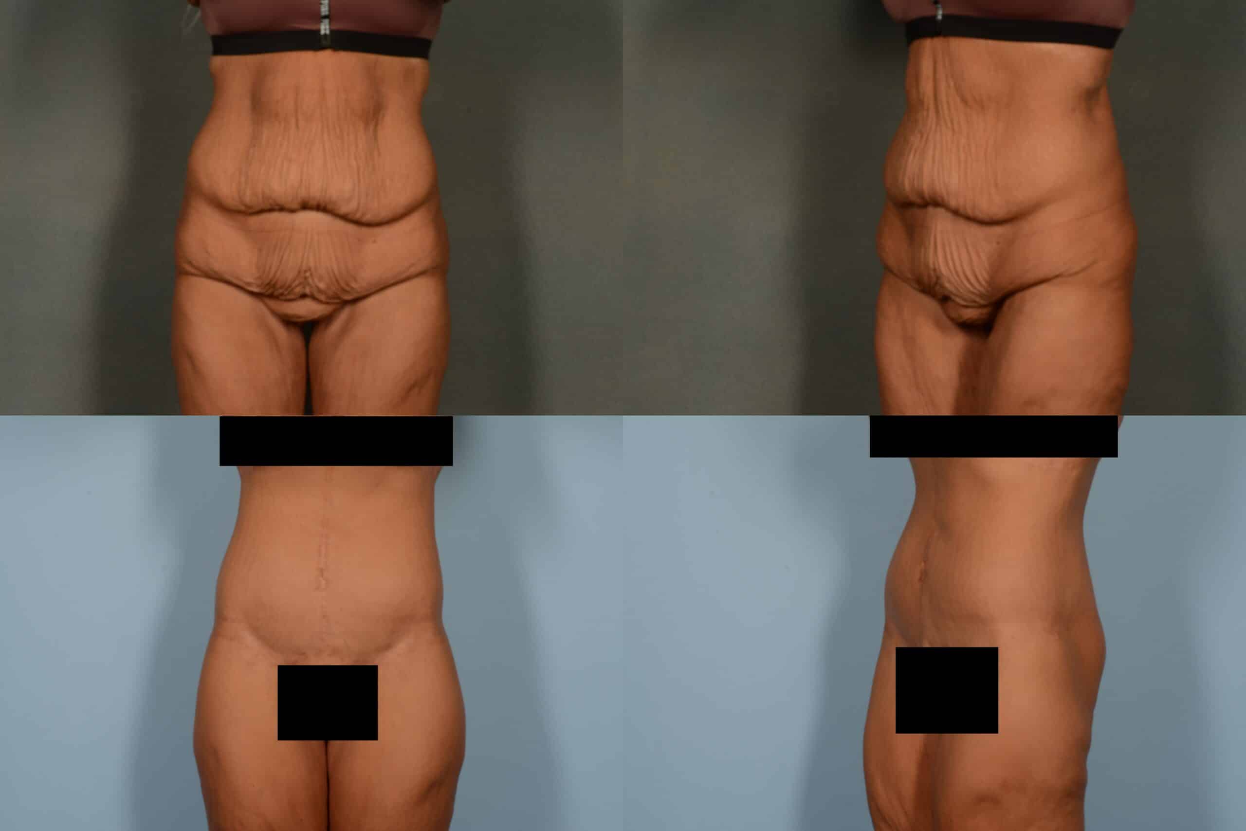 Tummy Tuck Case # 1133 Combined Image