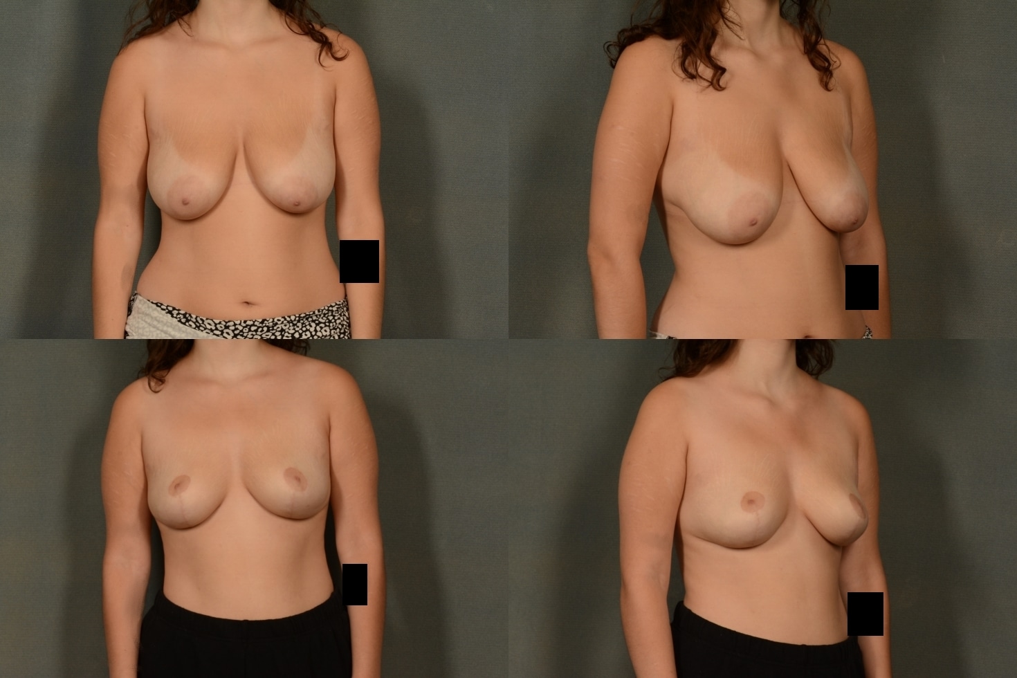 Breast Lift Case# 1001 Combined Image