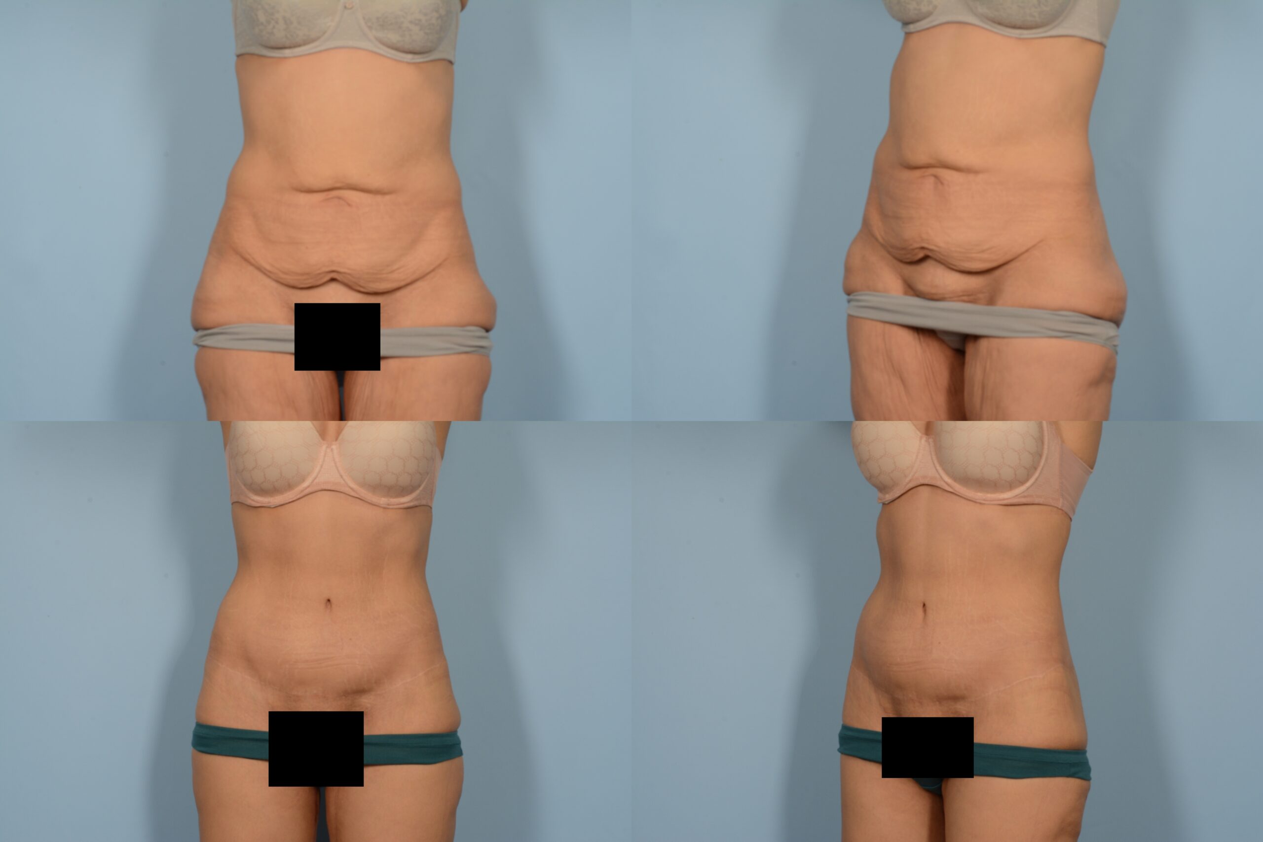 Tummy Tuck Case# 1135 Combined Image