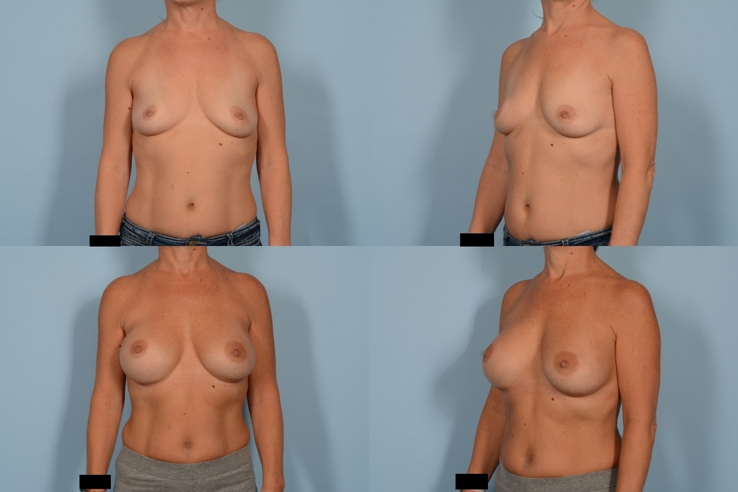 Breast Augmentation Case# 1116 Combined Image