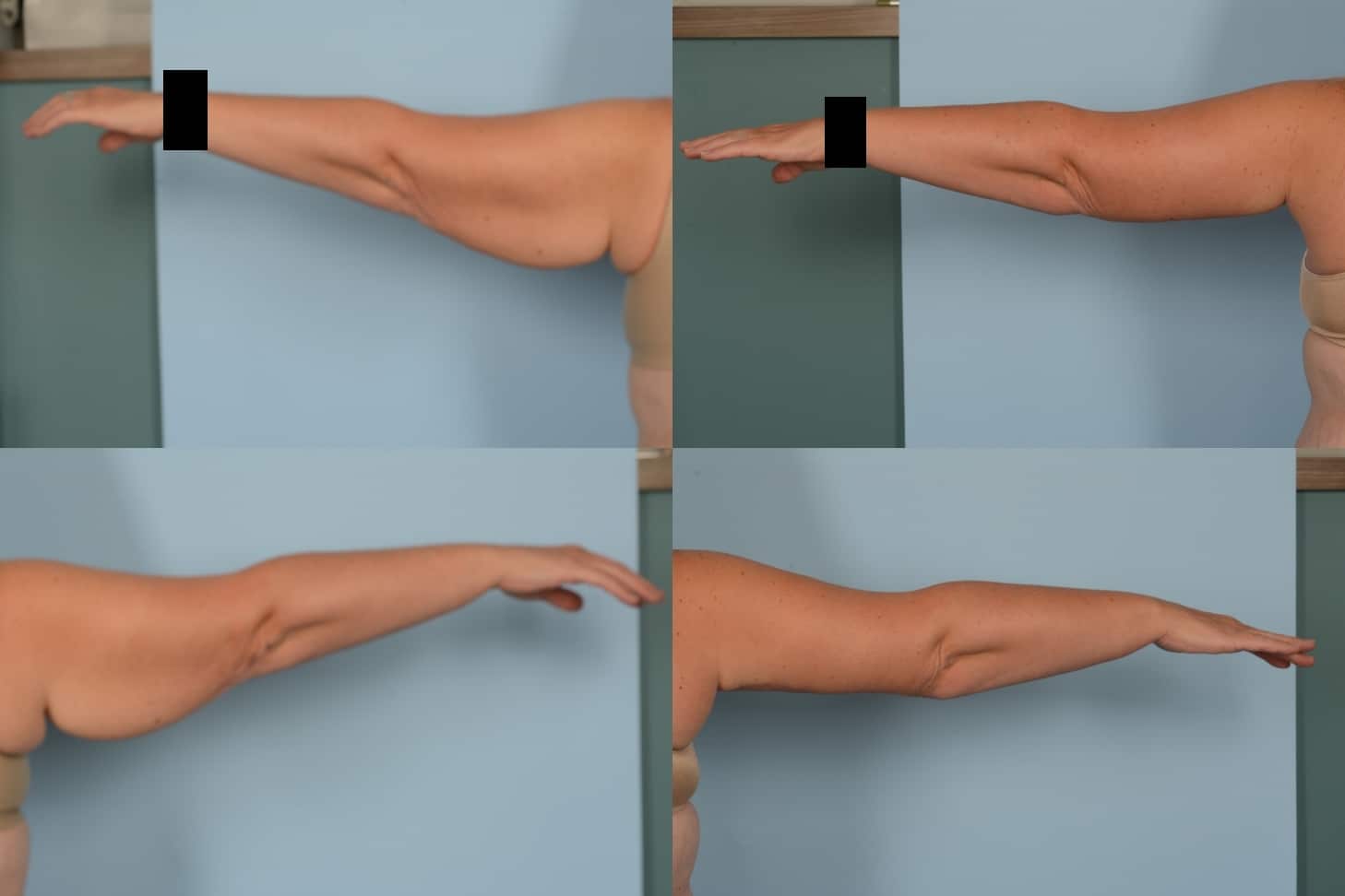 Arm Lift Case# 1128 Combined Image