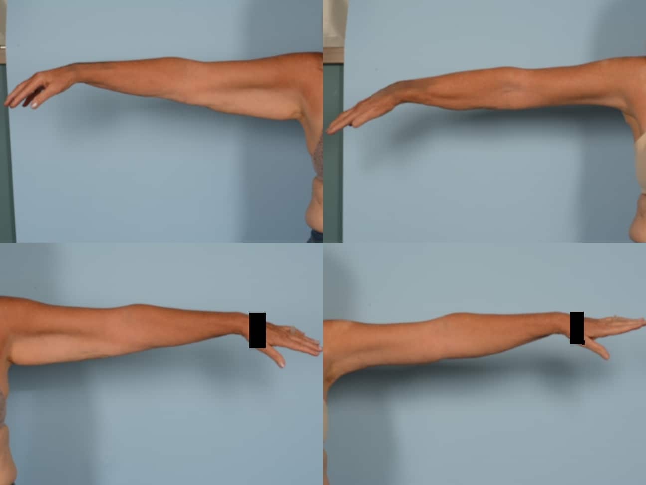 Arm Lift Case# 1173 Combined Image