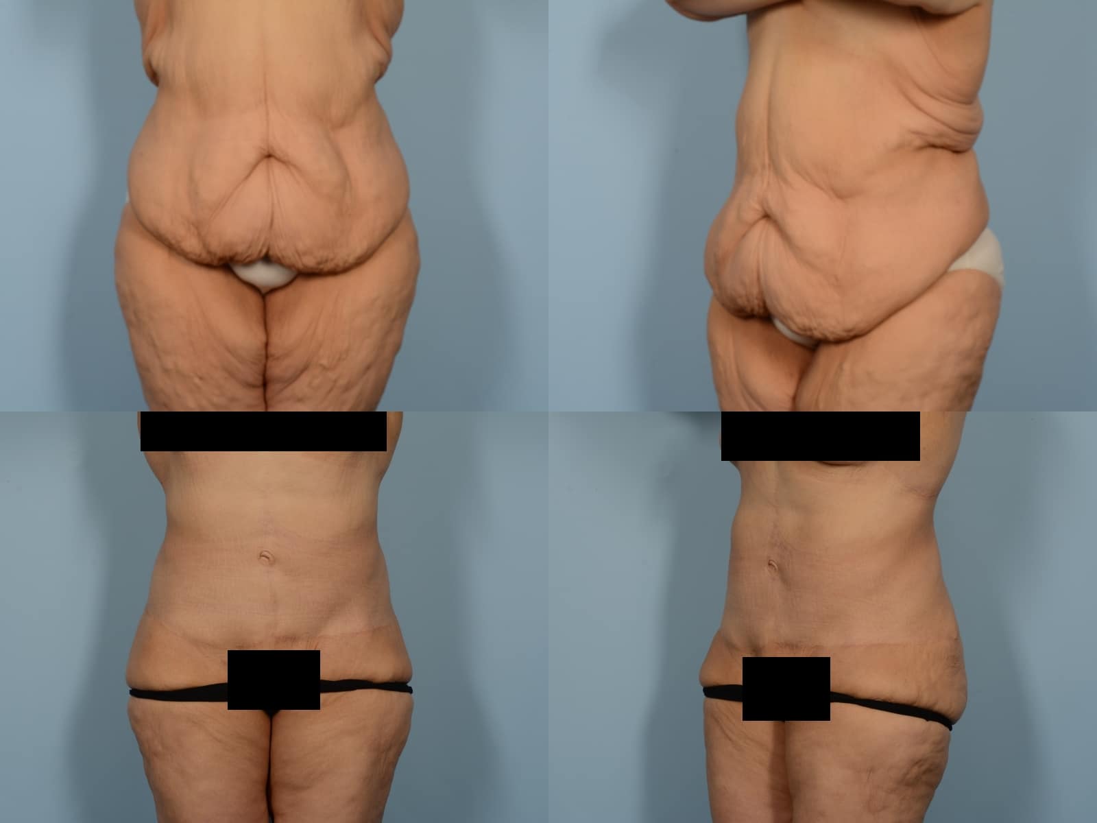 Tummy Tuck Case# 1182 Combined Image