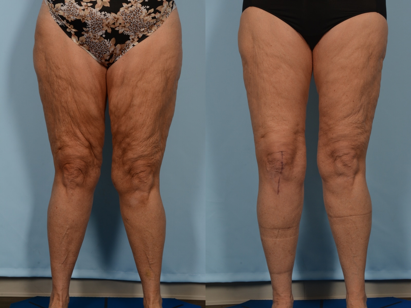 Thigh Lift Case# 1191 Combined Image